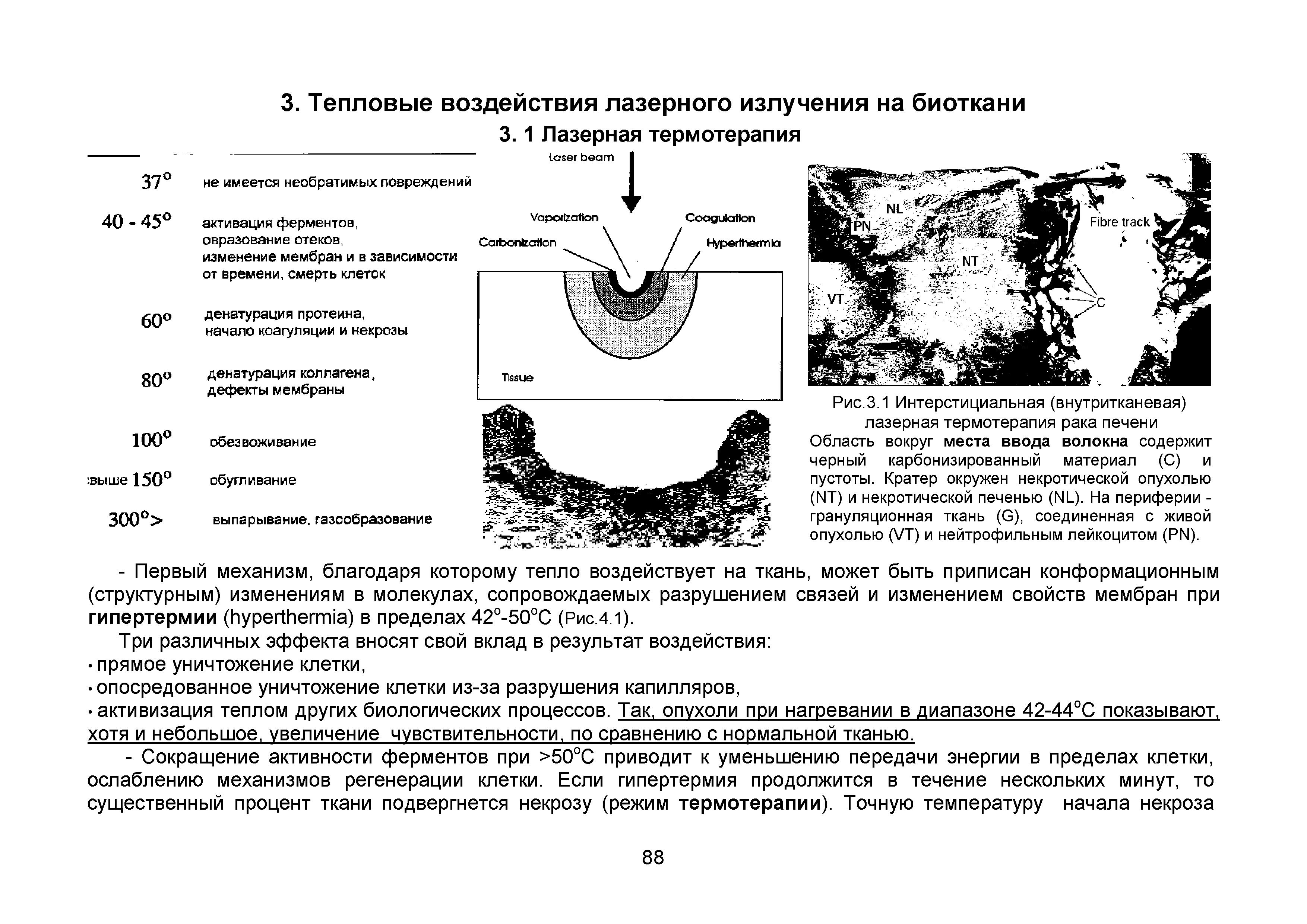 Рис.3.1 Интерстициальная (внутритканевая) лазерная термотерапия рака печени Область вокруг места ввода волокна содержит черный карбонизированный материал (С) и пустоты. Кратер окружен некротической опухолью (ЫТ) и некротической печенью (N1). На периферии -грануляционная ткань (С), соединенная с живой опухолью ( /Т) и нейтрофильным лейкоцитом (РЫ).