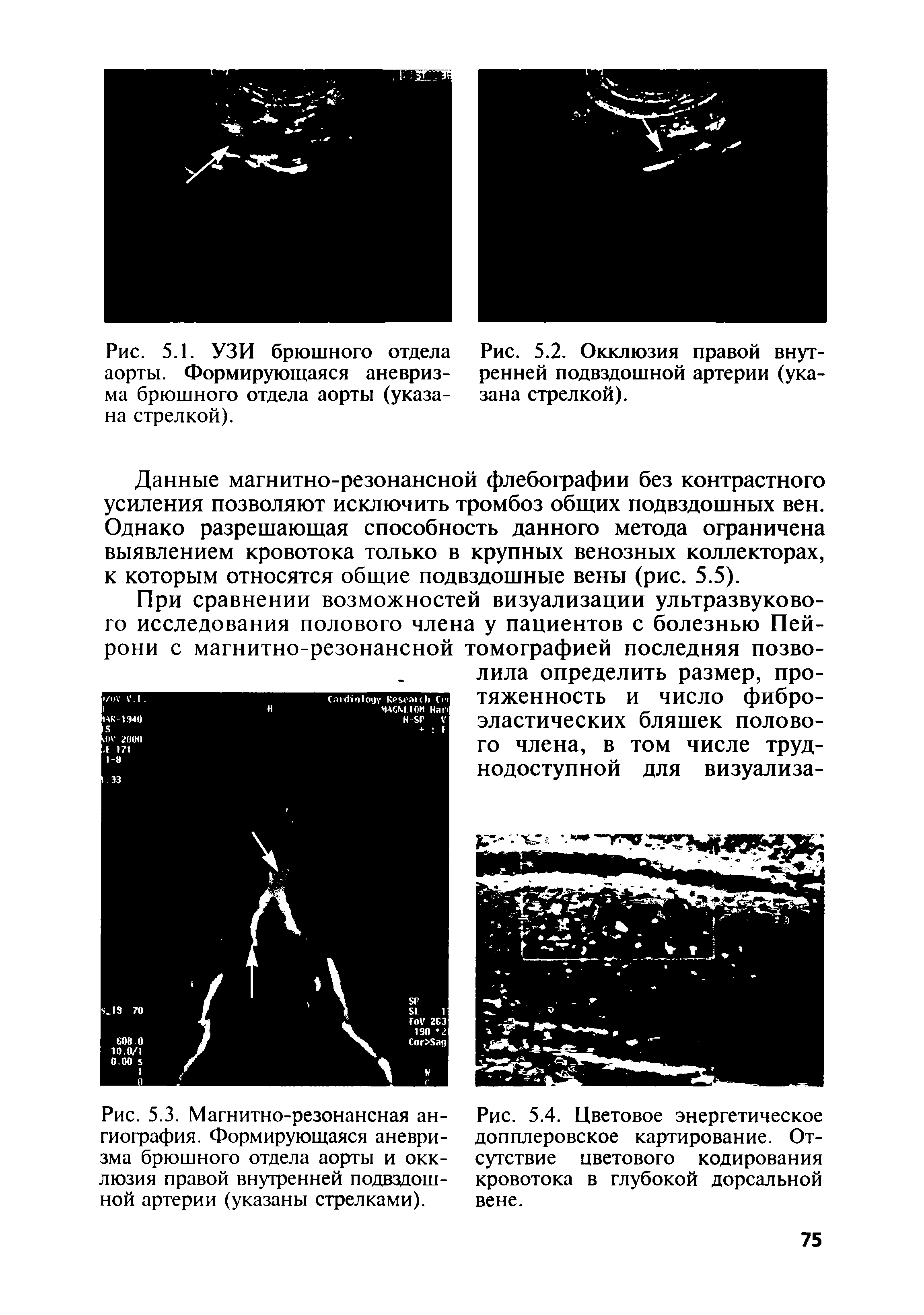 Рис. 5.4. Цветовое энергетическое допплеровское картирование. Отсутствие цветового кодирования кровотока в глубокой дорсальной вене.