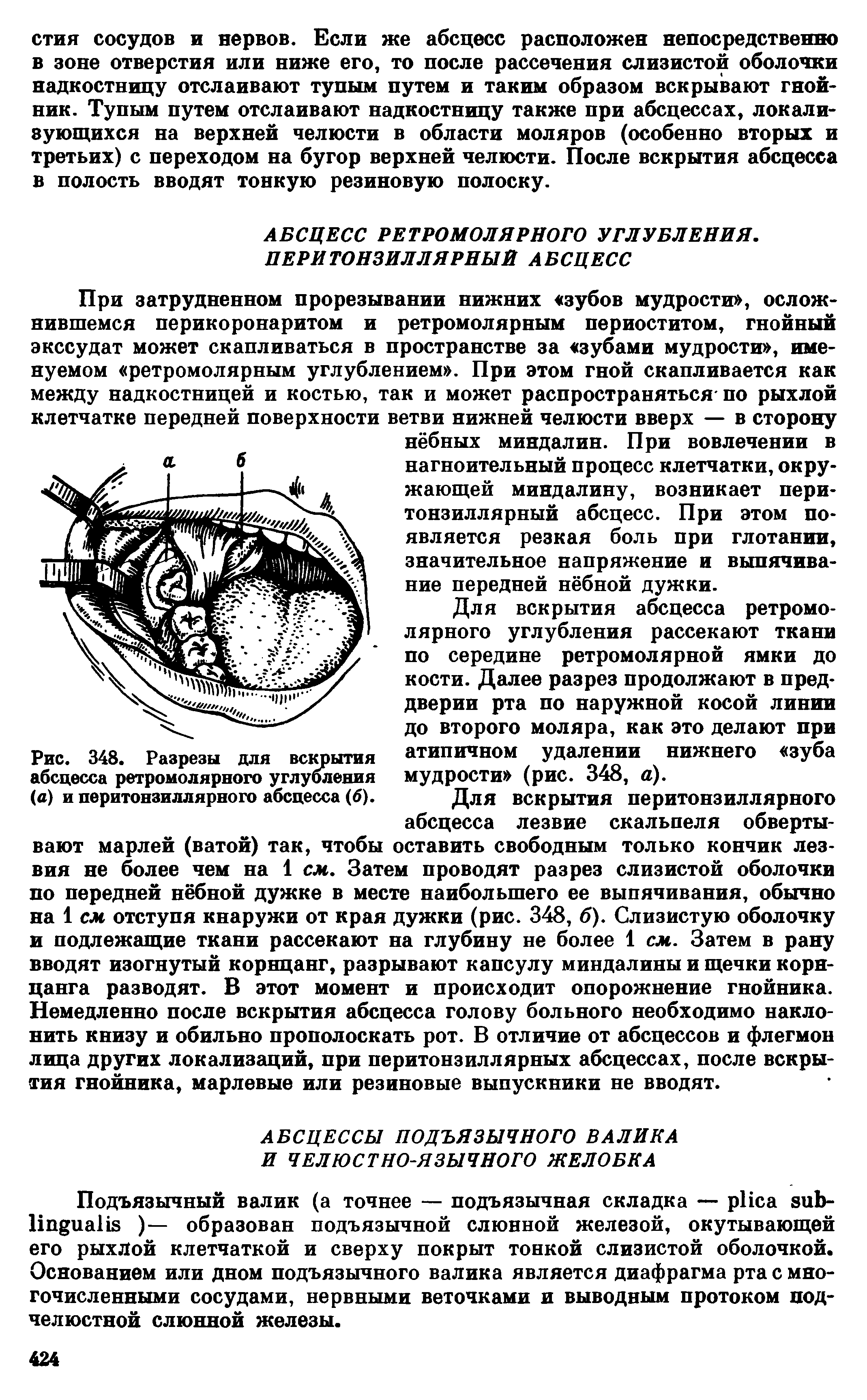 Рис. 348. Разрезы для вскрытия абсцесса ретромолярного углубления (а) и перитонзиллярного абсцесса (6).