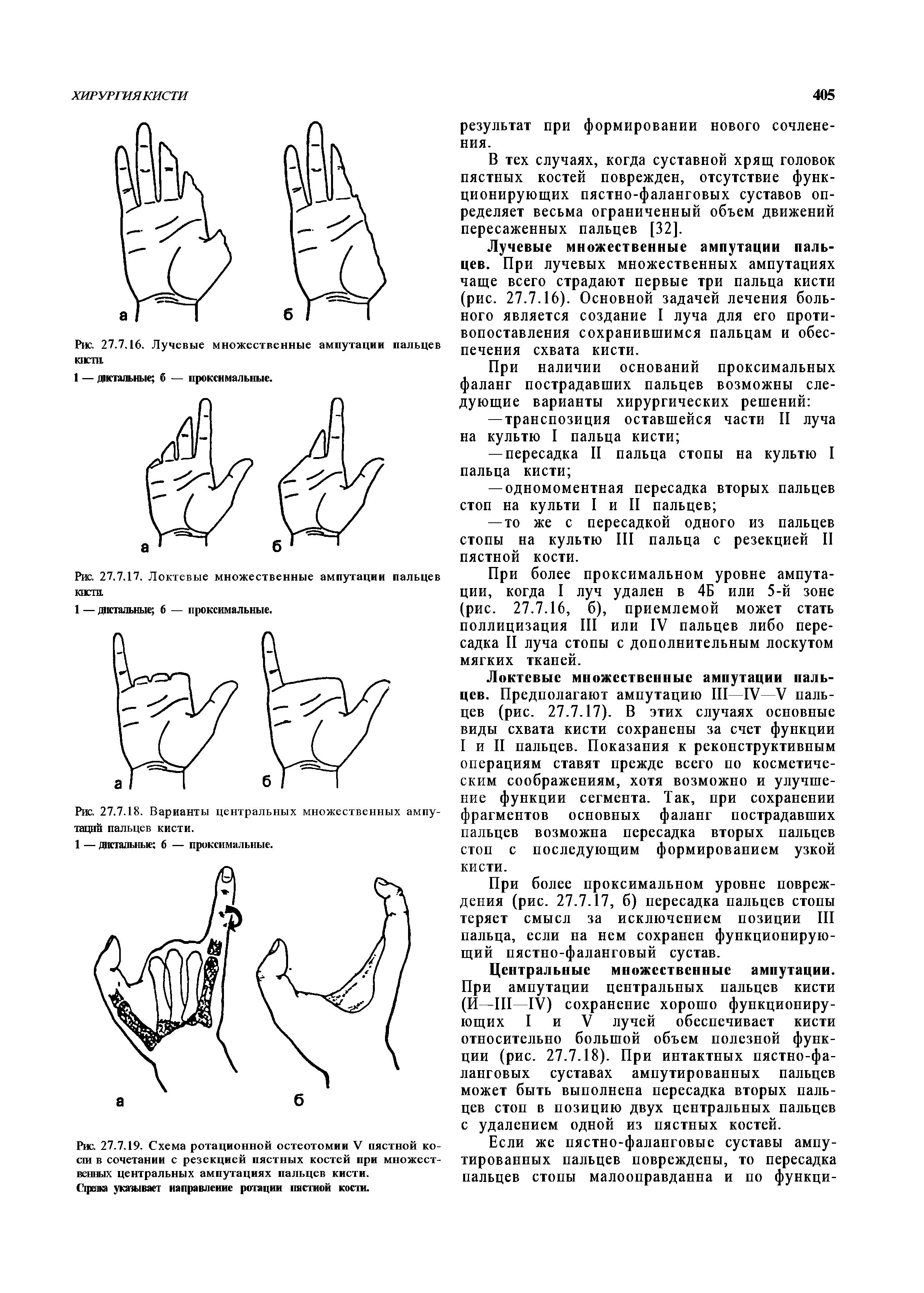 Ампутация пальцев код мкб. Ампутация и экзартикуляция пальцев кисти. Техника ампутации и экзартикуляции фаланг пальцев. Экзартикуляция кисти методика. Уровни ампутации пальцев кисти.