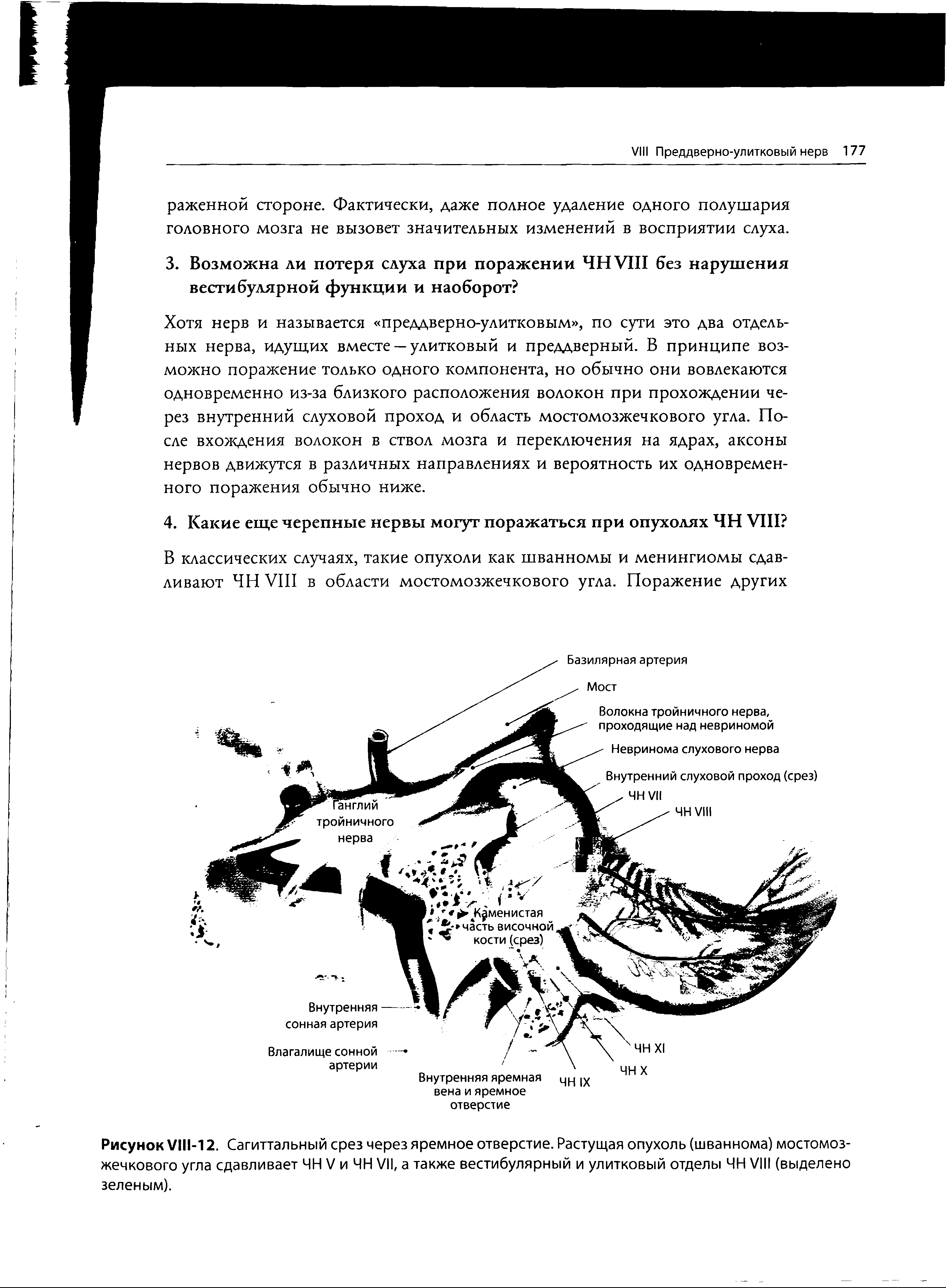 Рисунок VII1-12. Сагиттальный срез через яремное отверстие. Растущая опухоль (шваннома) мостомозжечкового угла сдавливает ЧН V и ЧН VII, а также вестибулярный и улитковый отделы ЧН VIII (выделено зеленым).