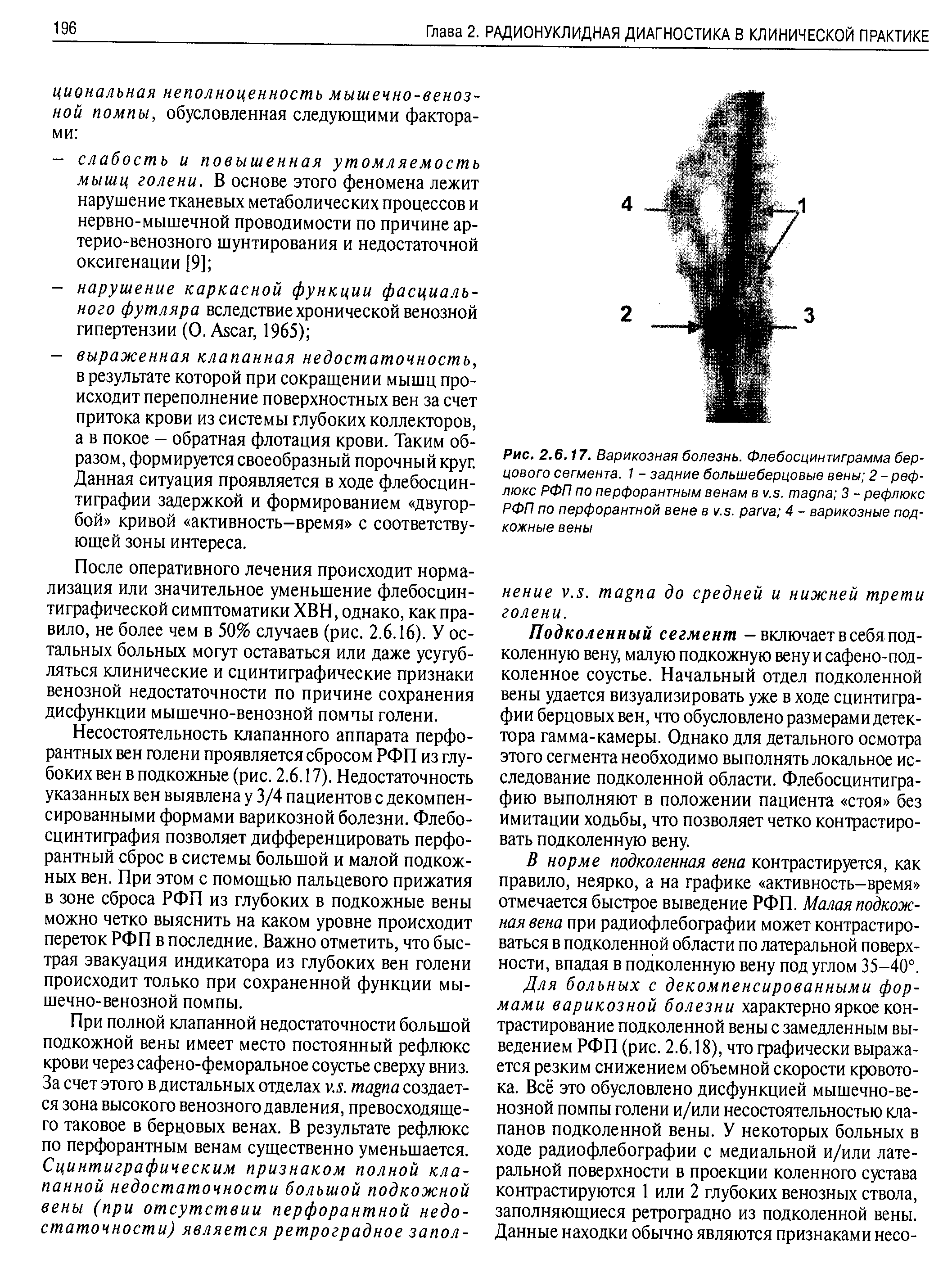 Рис. 2.6.17. Варикозная болезнь. Флебосцинтиграмма берцового сегмента. 1 - задние большеберцовые вены 2 - рефлюкс РФП по перфорантным венам в . . 3 - рефлюкс РФП по перфорантной вене в . . 4 - варикозные подкожные вены...