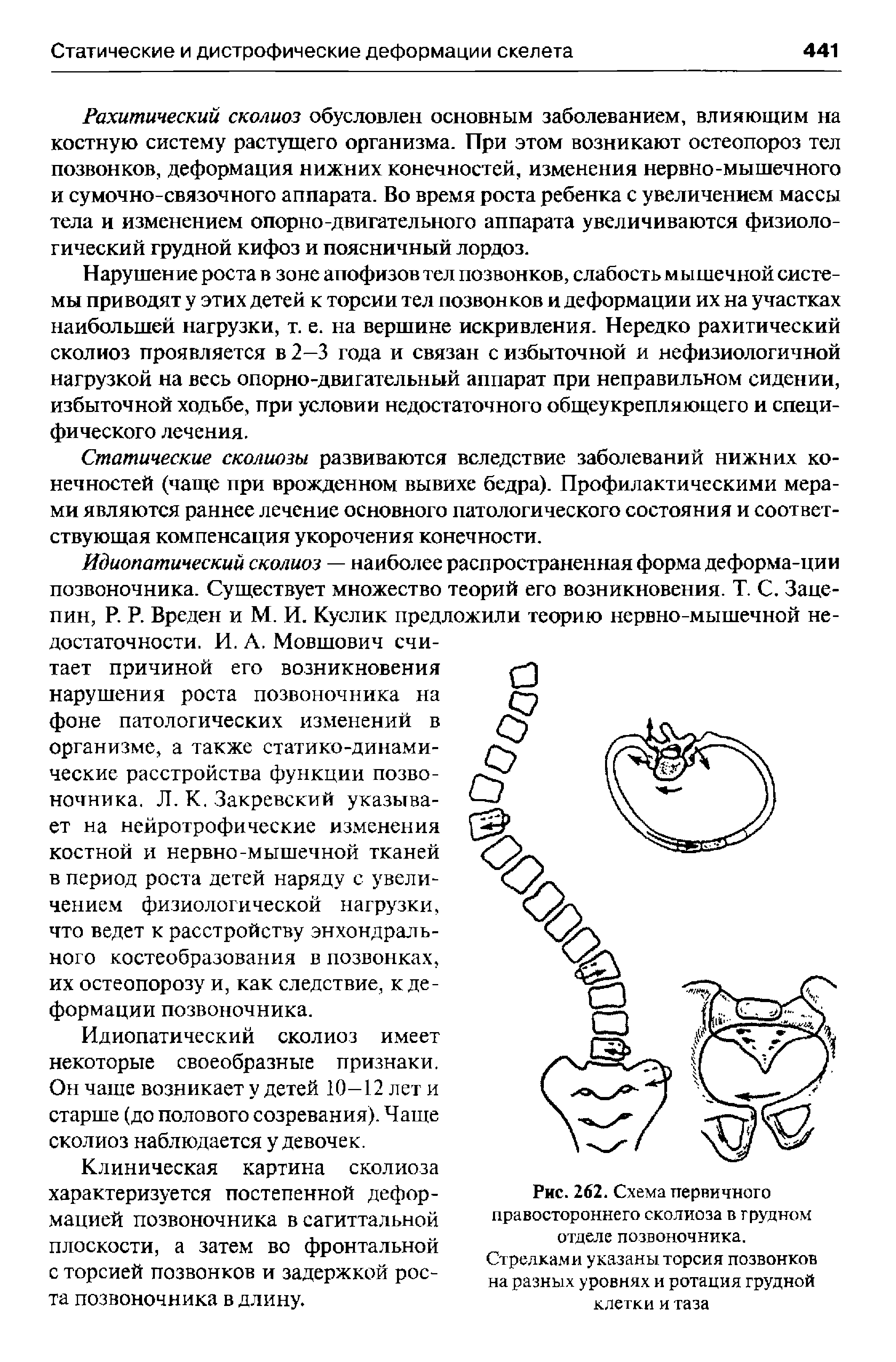 Рис. 262. Схема первичного правостороннего сколиоза в грудном отделе позвоночника. Стрелками указаны торсия позвонков на разных уровнях и ротация грудной клетки и таза...