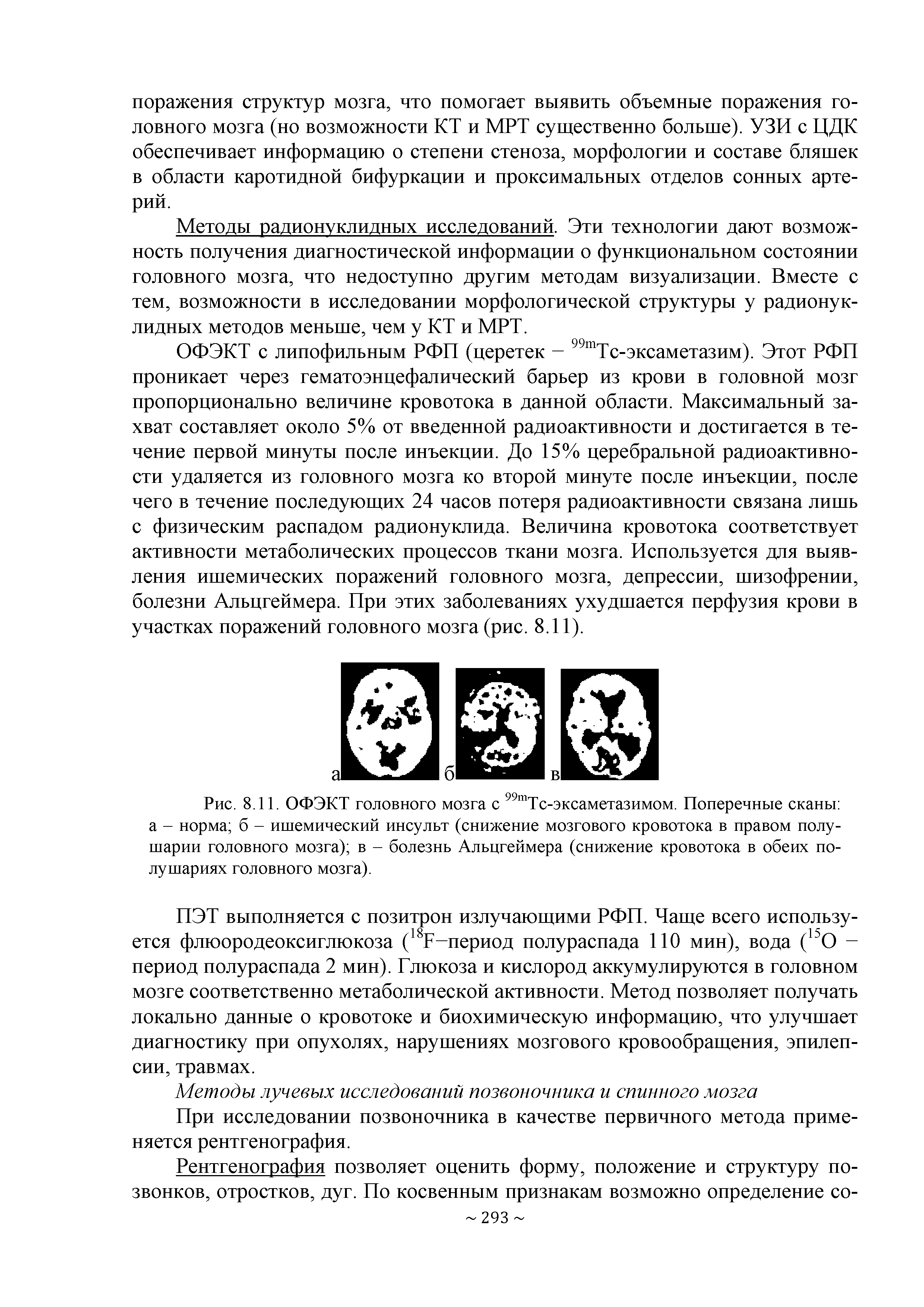 Рис. 8.11. ОФЭКТ головного мозга с 99тТс-эксаметазимом. Поперечные сканы а - норма б - ишемический инсульт (снижение мозгового кровотока в правом полушарии головного мозга) в - болезнь Альцгеймера (снижение кровотока в обеих полушариях головного мозга).