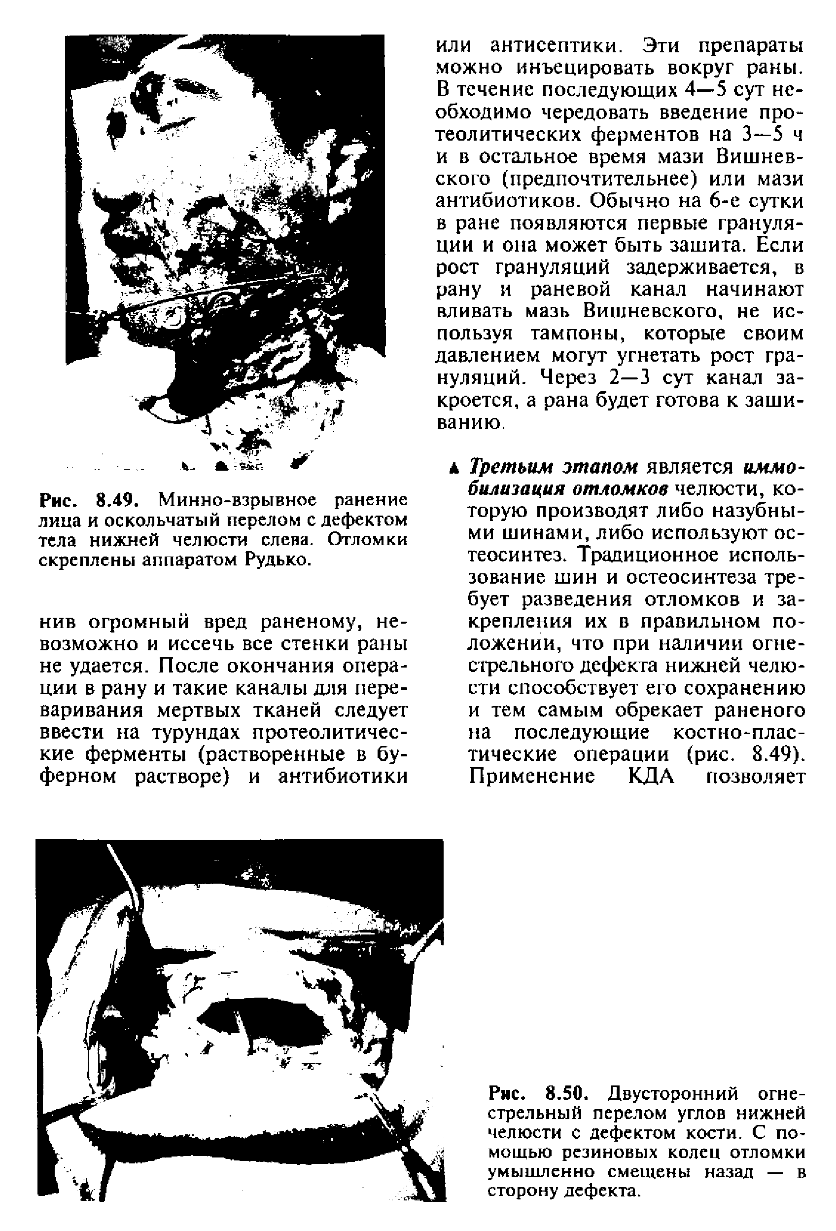 Рис. 8.50. Двусторонний огнестрельный перелом углов нижней челюсти с дефектом кости. С помощью резиновых колец отломки умышленно смещены назад — в сторону дефекта.