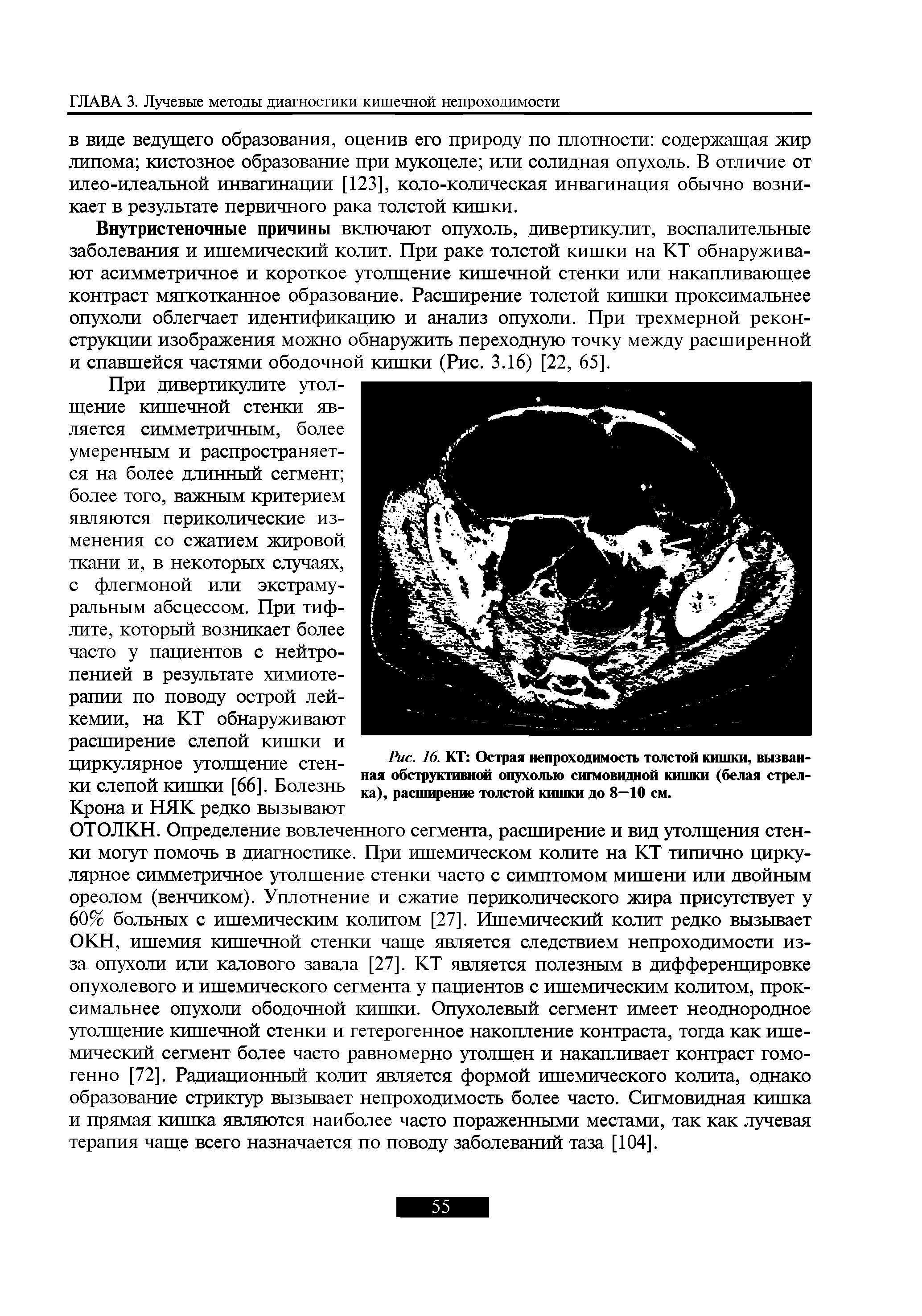 Рис. 16. КТ Острая непроходимость толстой кишки, вызванная обструктивной опухолью сигмовидной кишки (белая стрелка), расширение толстой кишки до 8—10 см.