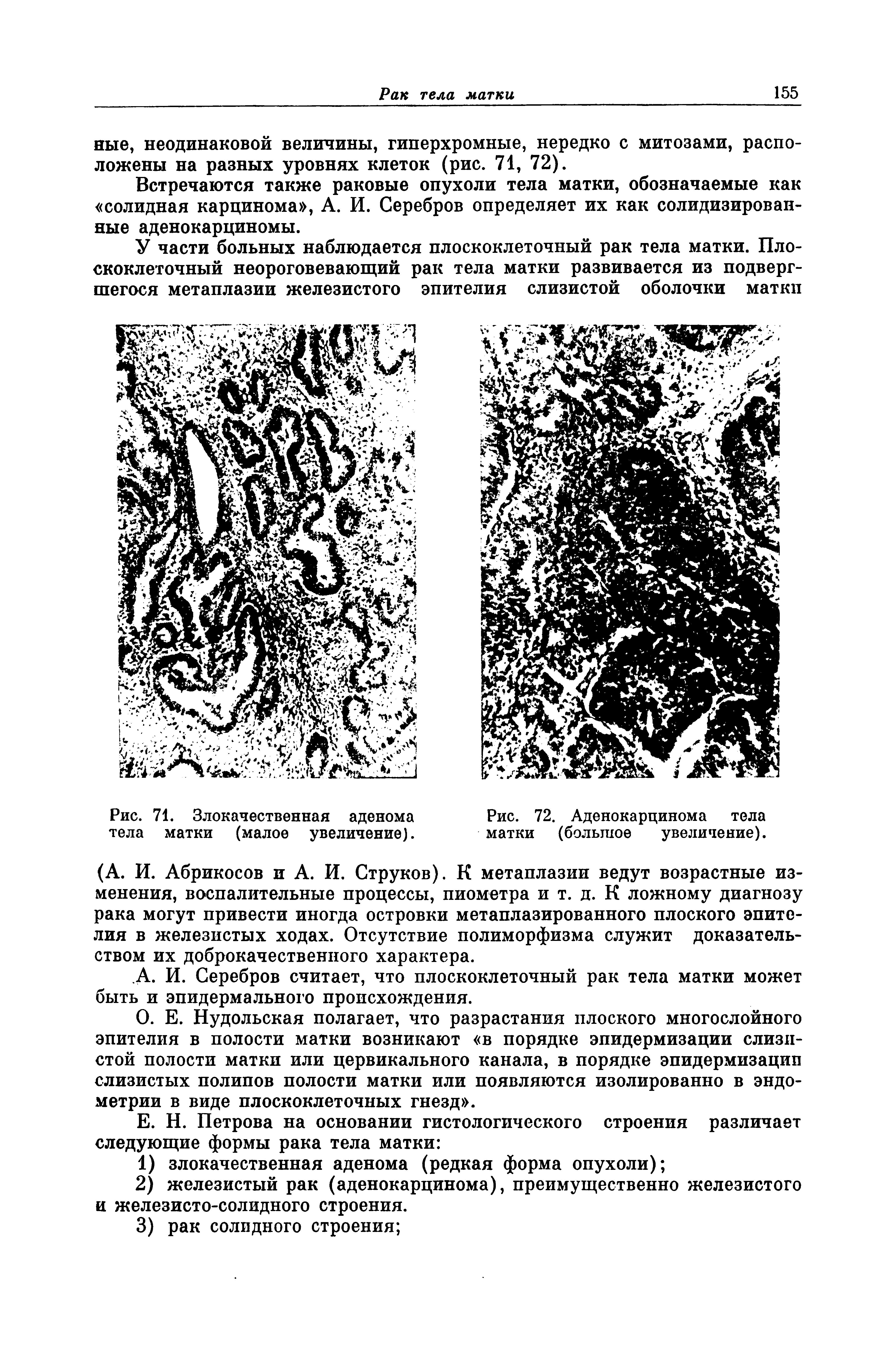 Рис. 71. Злокачественная аденома тела матки (малое увеличение).