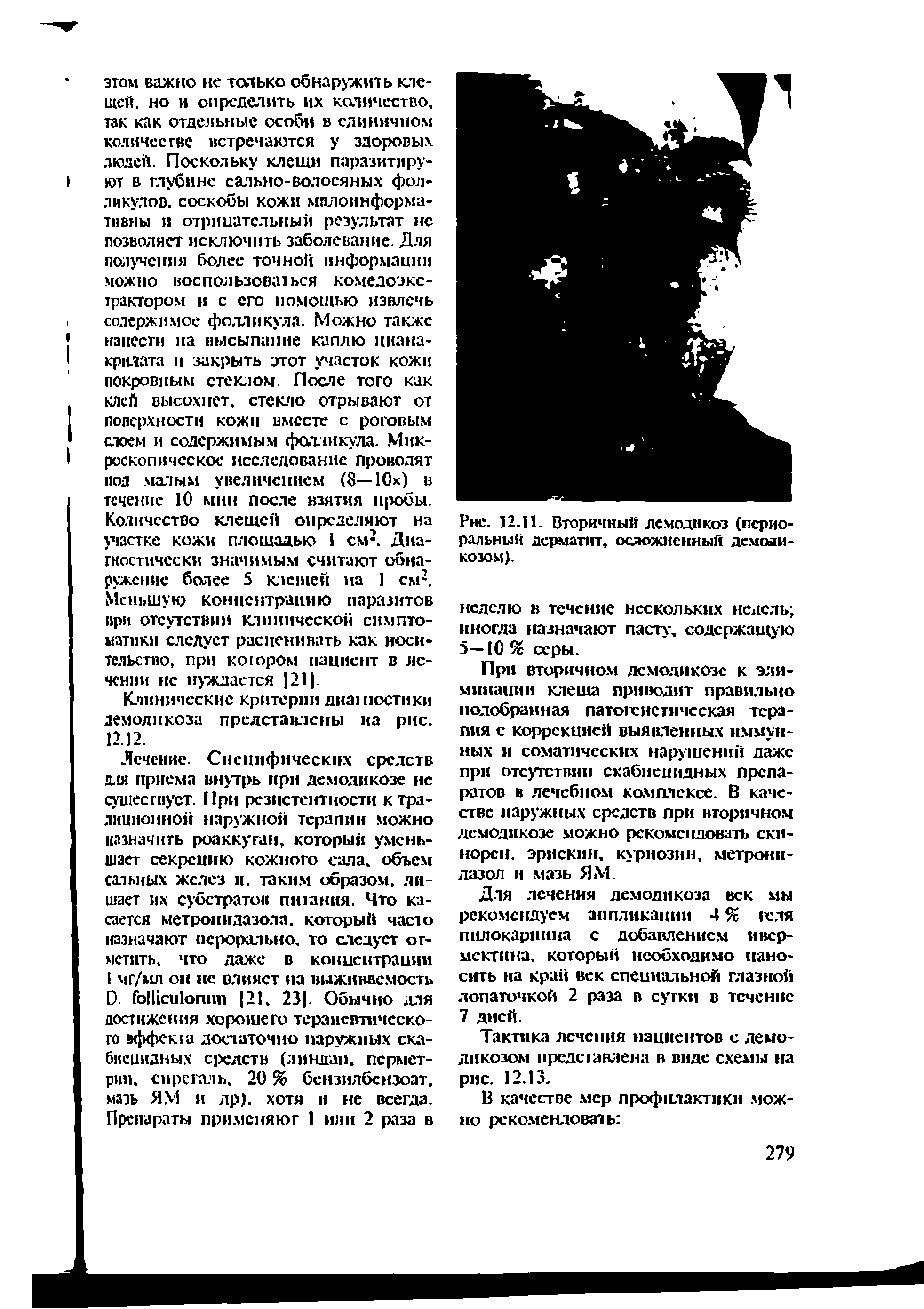 Рис. 12.11. Вторичный ле.моднкоз (псрио-ральный дерматит, осложненный дс.мсыи-козом).