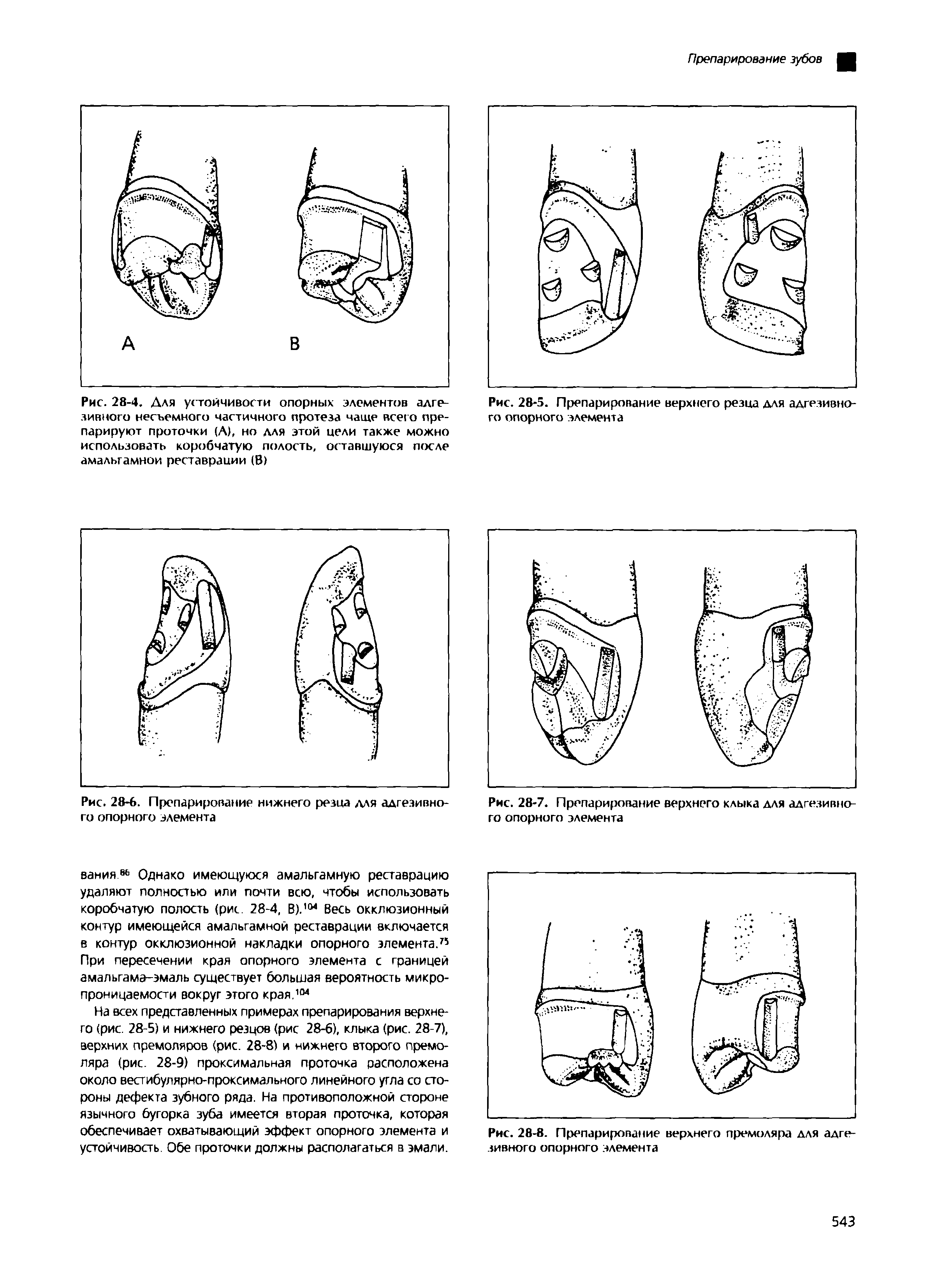 Рис. 28-4. Для устойчивости опорных элементов адгезивного несъемного частичного протеза чаще всего препарируют проточки (А), но для этой цели также можно использовать коробчатую полость, оставшуюся после амальгамной реставрации (В)...