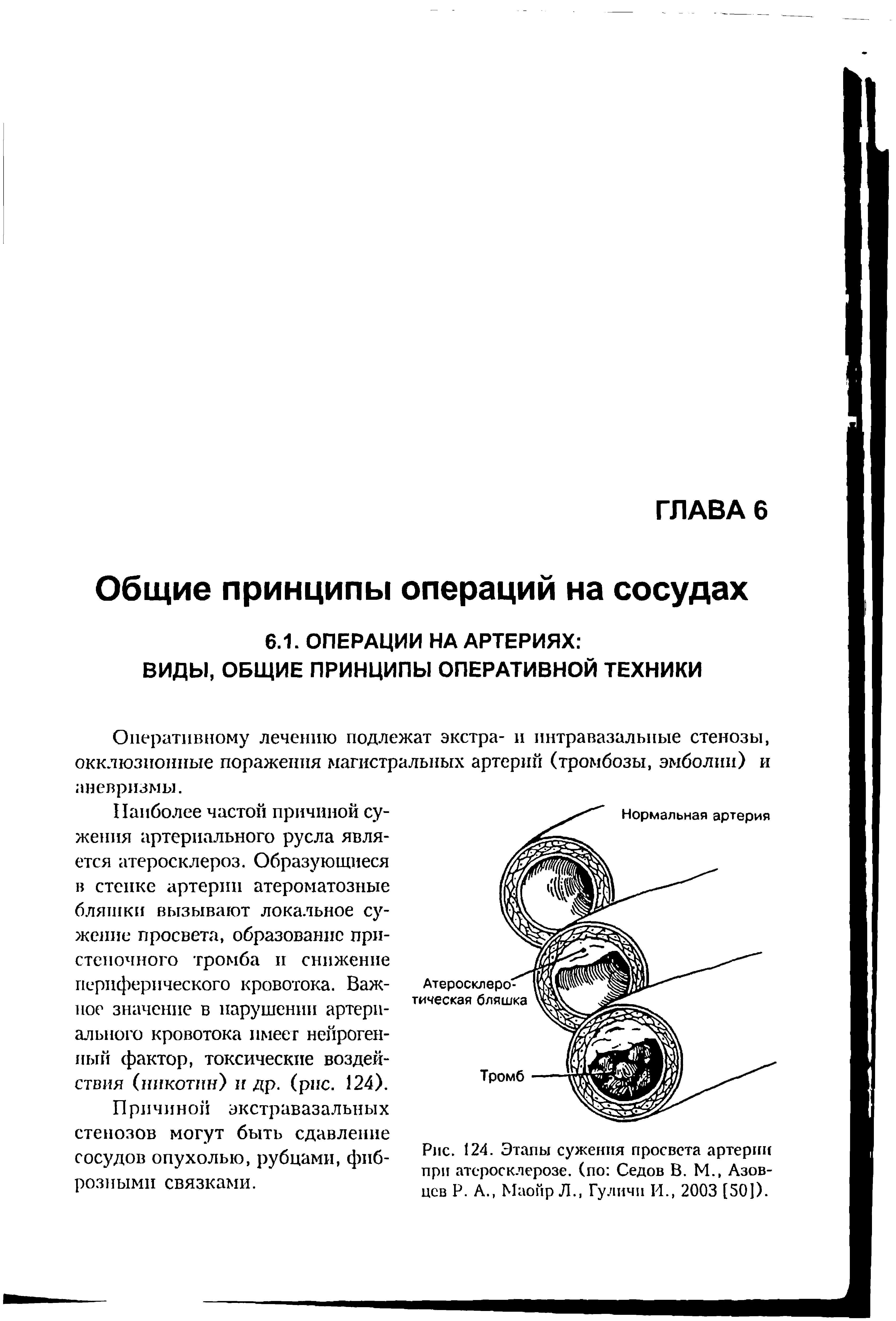 Рис. 124. Этапы сужения просвета артерии при атеросклерозе, (по Седов В. М., Азов-цсв Р. А., Маойр Л., Гуличп И., 2003 [50]).