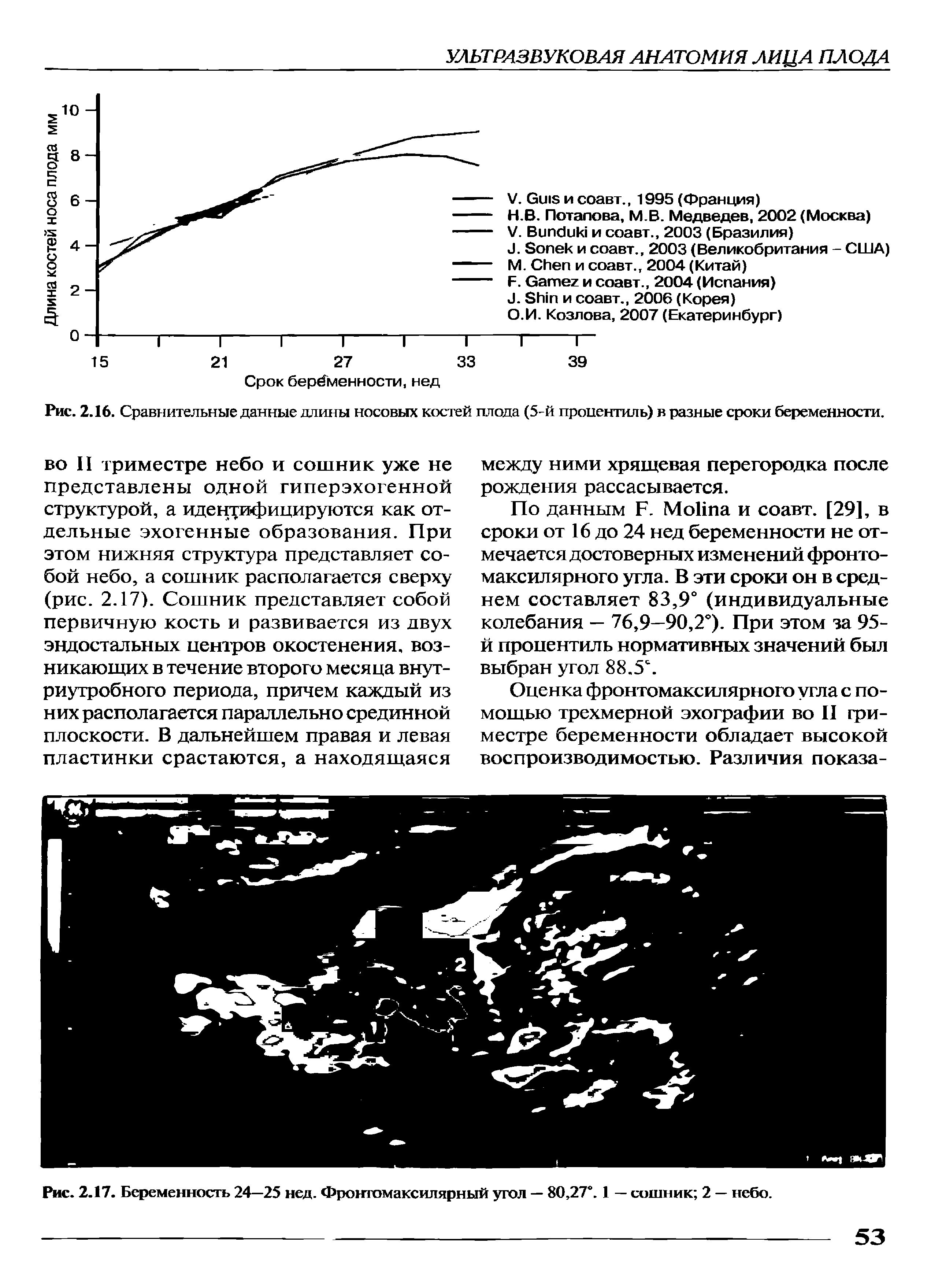 Рис. 2.16. Сравнительные данные длины носовых костей плода (5-й процентиль) в разные сроки беременности.