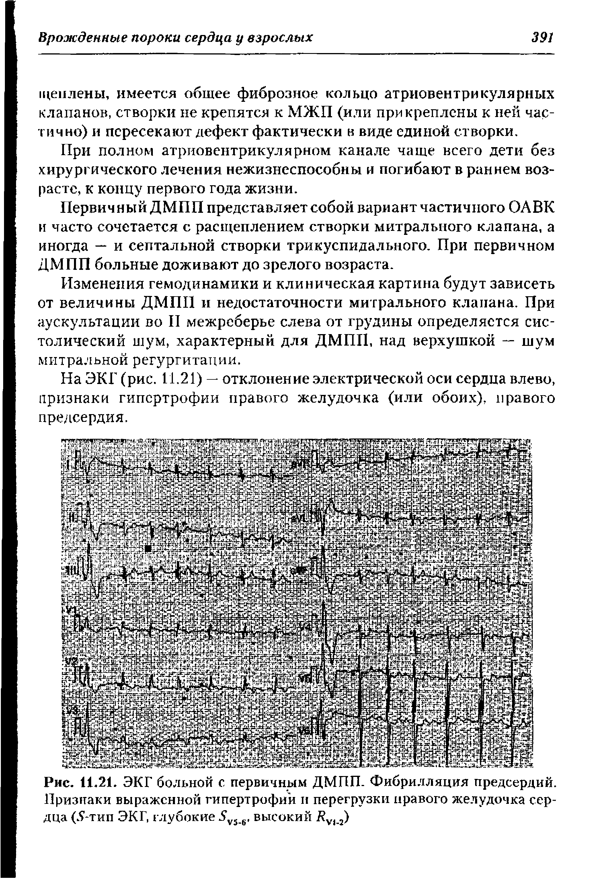 Рис. 11.21. ЭКГ больной с первичным ДМПП. Фибрилляция предсердий. Признаки выраженной гипертрофий и перегрузки правого желудочка сердца (5-тип ЭКГ, глубокие 5у5 6, высокий 2)...