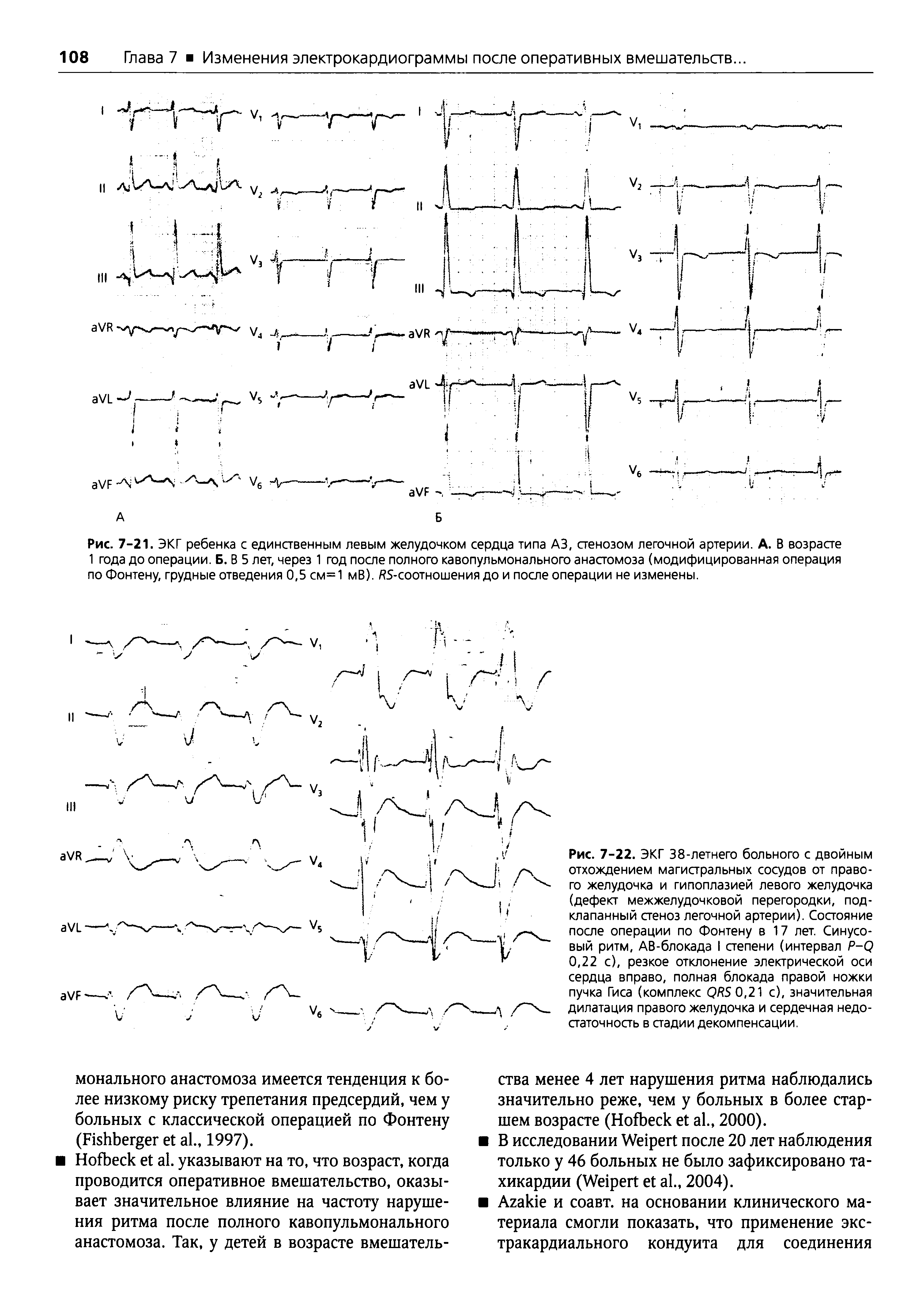 Рис. 7-21. ЭКГ ребенка с единственным левым желудочком сердца типа АЗ, стенозом легочной артерии. А. В возрасте 1 года до операции. Б. В 5 лет, через 1 год после полного кавопульмонального анастомоза (модифицированная операция по Фонтену, грудные отведения 0,5 см=1 мВ), -соотношения до и после операции не изменены.
