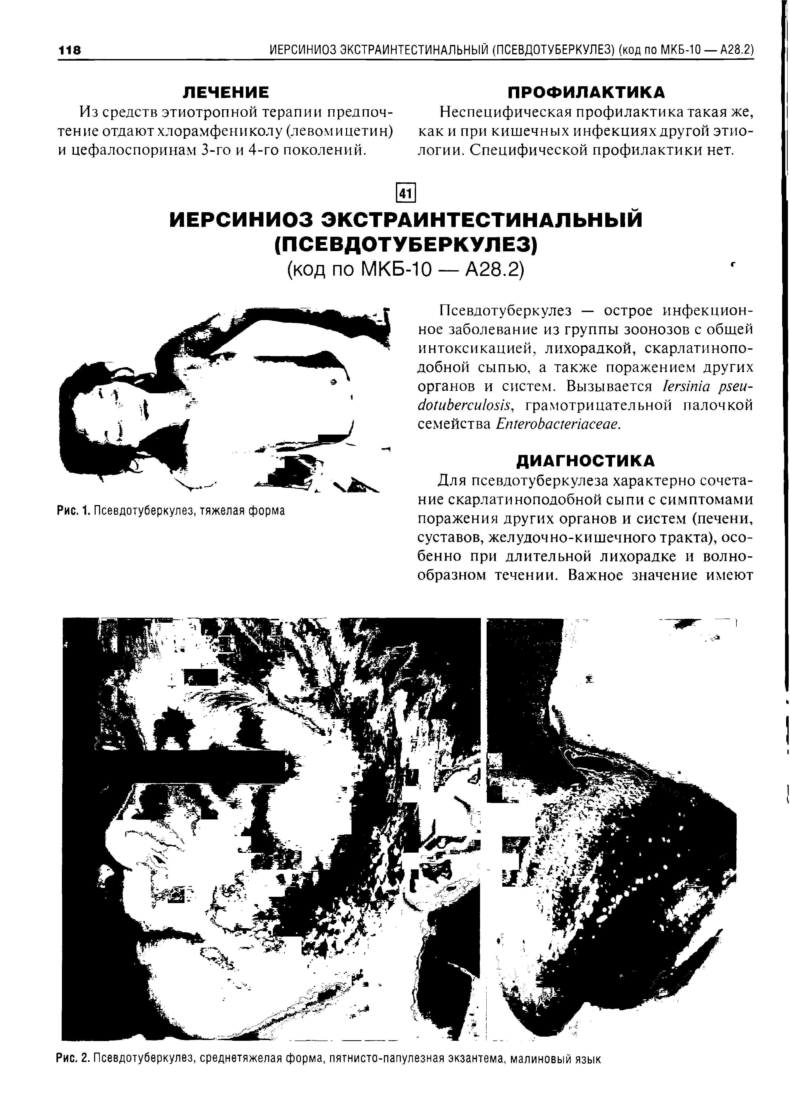 Рис. 2. Псевдотуберкулез, среднетяжелая форма, пятнисто-папулезная экзантема, малиновый язык...