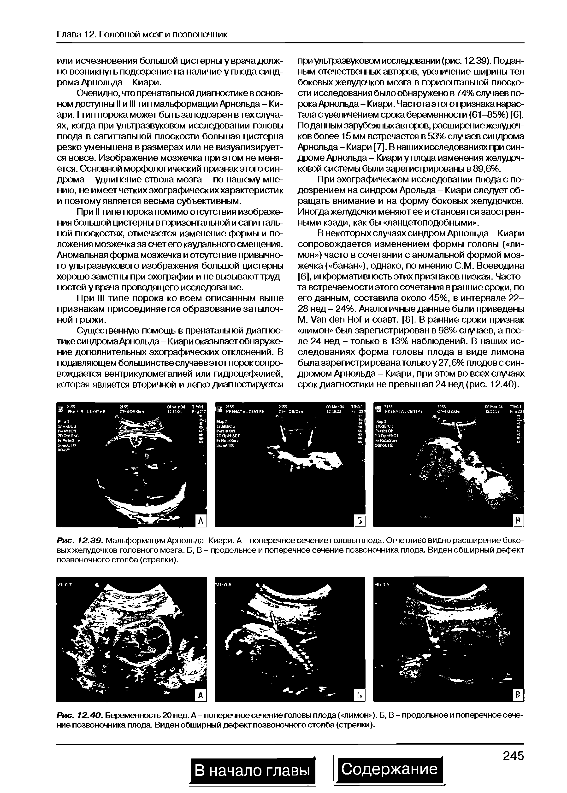 Рис. 12.39. Мальформация Арнольда-Киари. А - поперечное сечение головы плода. Отчетливо видно расширение боко-выхжелудочков головного мозга. Б, В - продольное и поперечное сечение позвоночника плода. Виден обширный дефект позвоночного столба (стрелки).