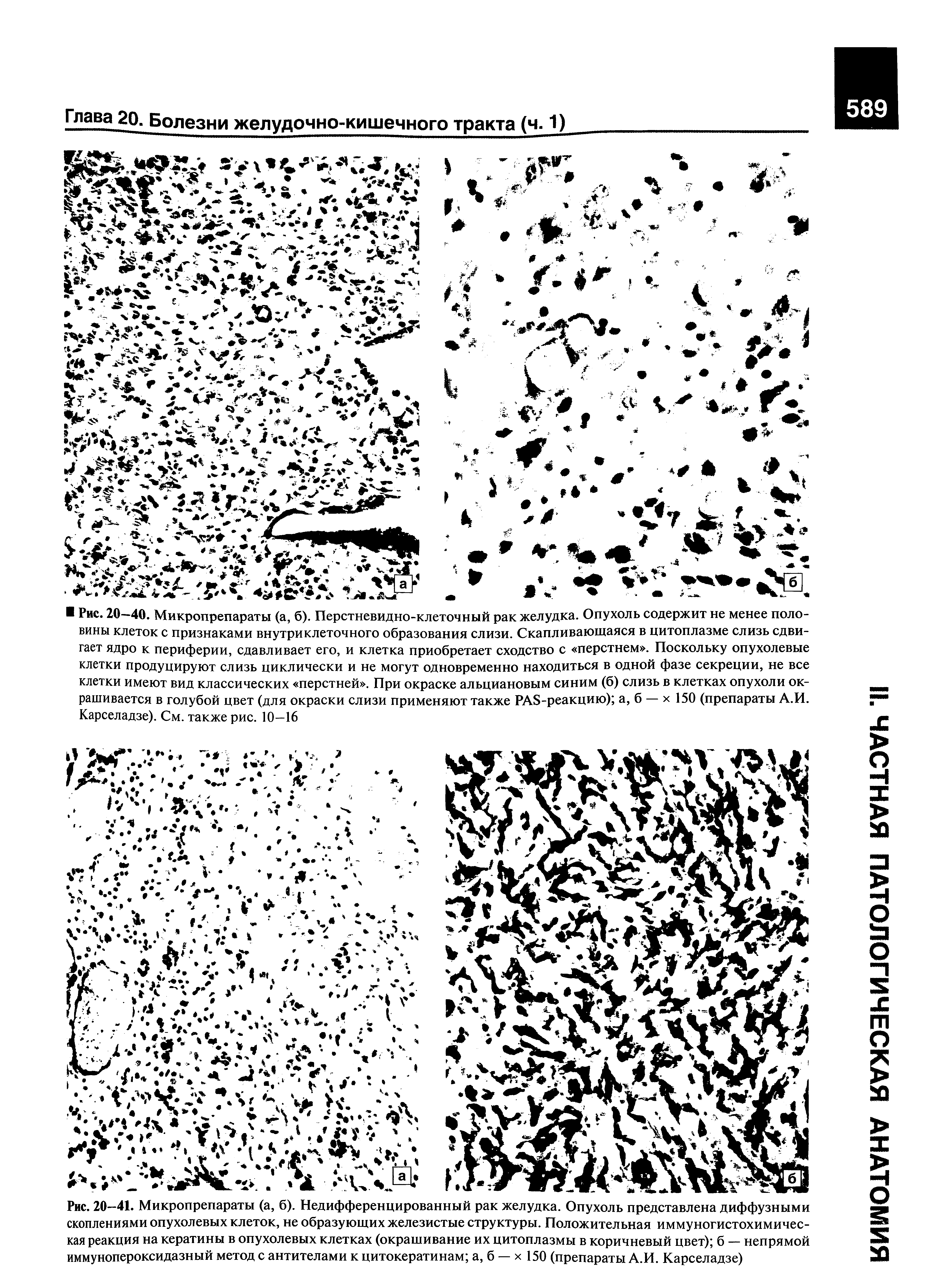 Рис. 20-41. Микропрепараты (а, б). Недифференцированный рак желудка. Опухоль представлена диффузными скоплениями опухолевых клеток, не образующих железистые структуры. Положительная иммуногистохимическая реакция на кератины в опухолевых клетках (окрашивание их цитоплазмы в коричневый цвет) б — непрямой иммунопероксидазный метод с антителами к цитокератинам а, б — х 150 (препараты А.И. Карселадзе)...