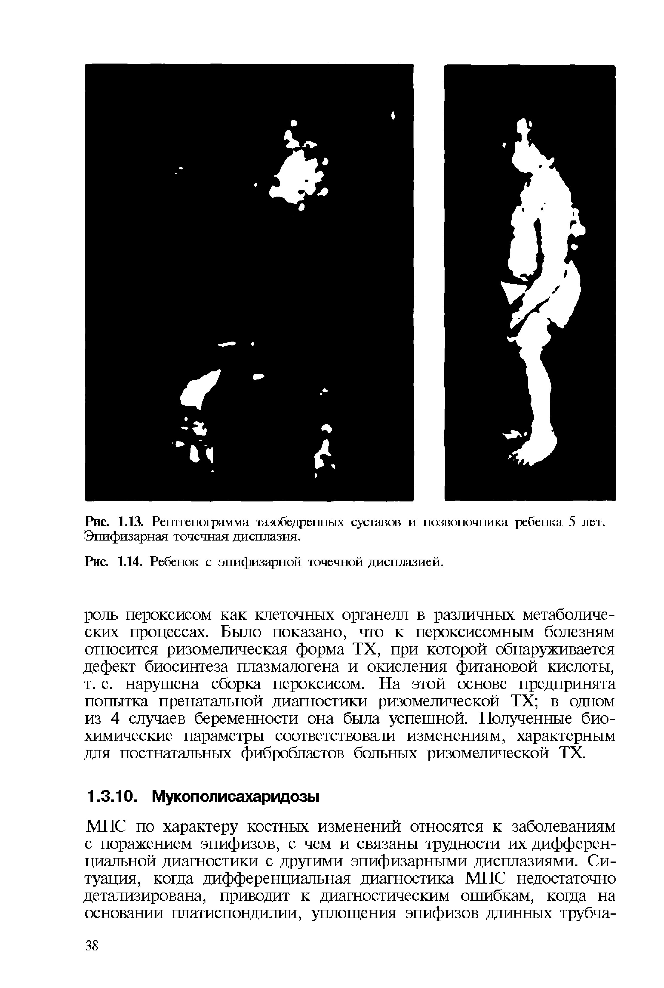 Рис. 1.13. Рентгенограмма тазобедренных суставов и позвоночника ребенка 5 лет. Эпифизарная точечная дисплазия.