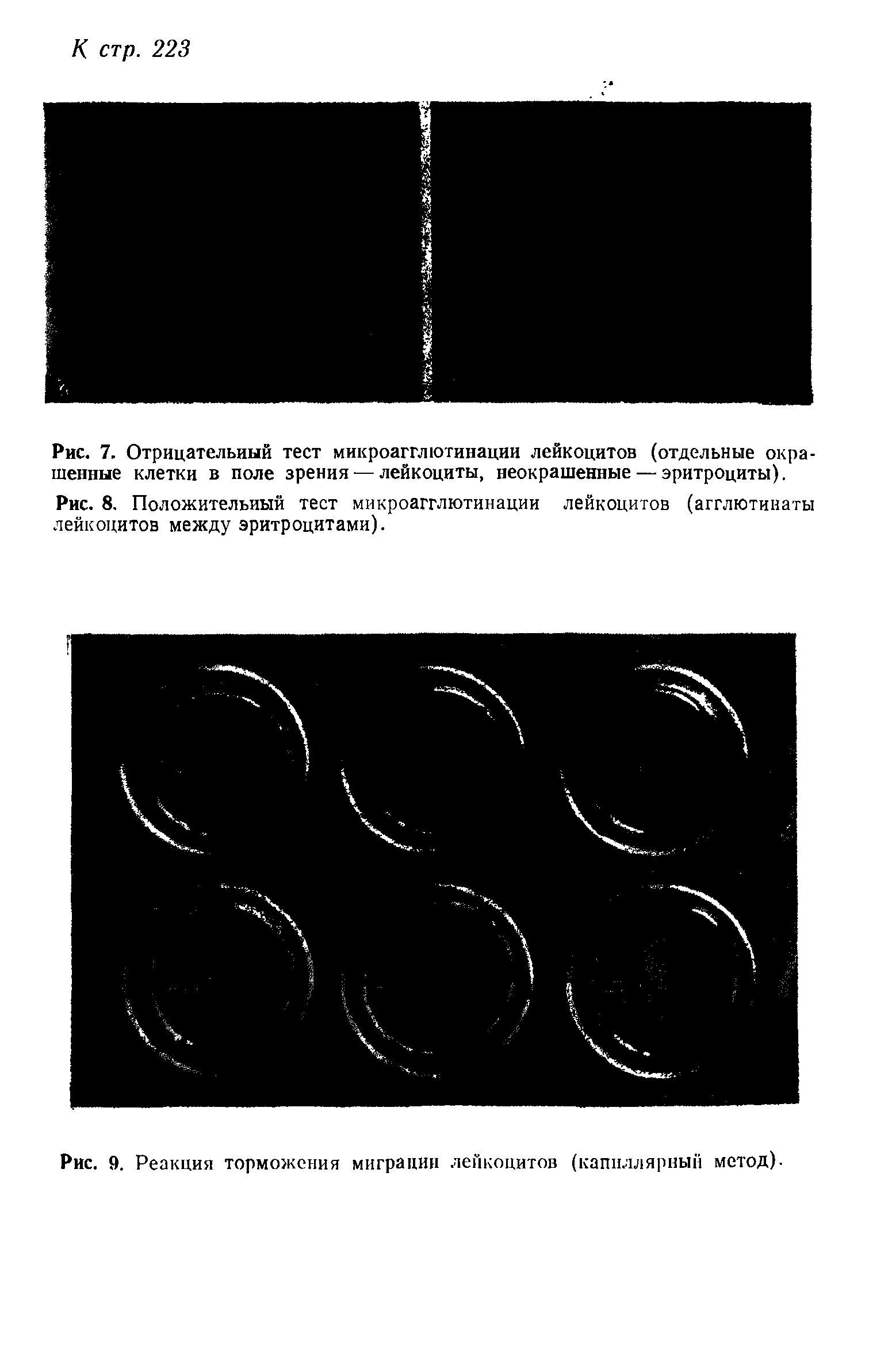 Рис. 9. Реакция торможения миграции лейкоцитов (капиллярный метод).