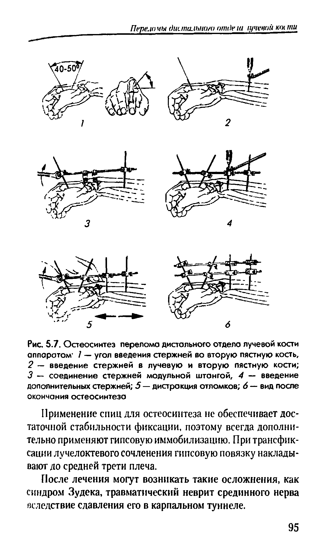 Рис. 5.7. Остеосинтез переломе дистального отдело лучевой кости аппаротом / — угол введения стержней во вторую пястную кость,...