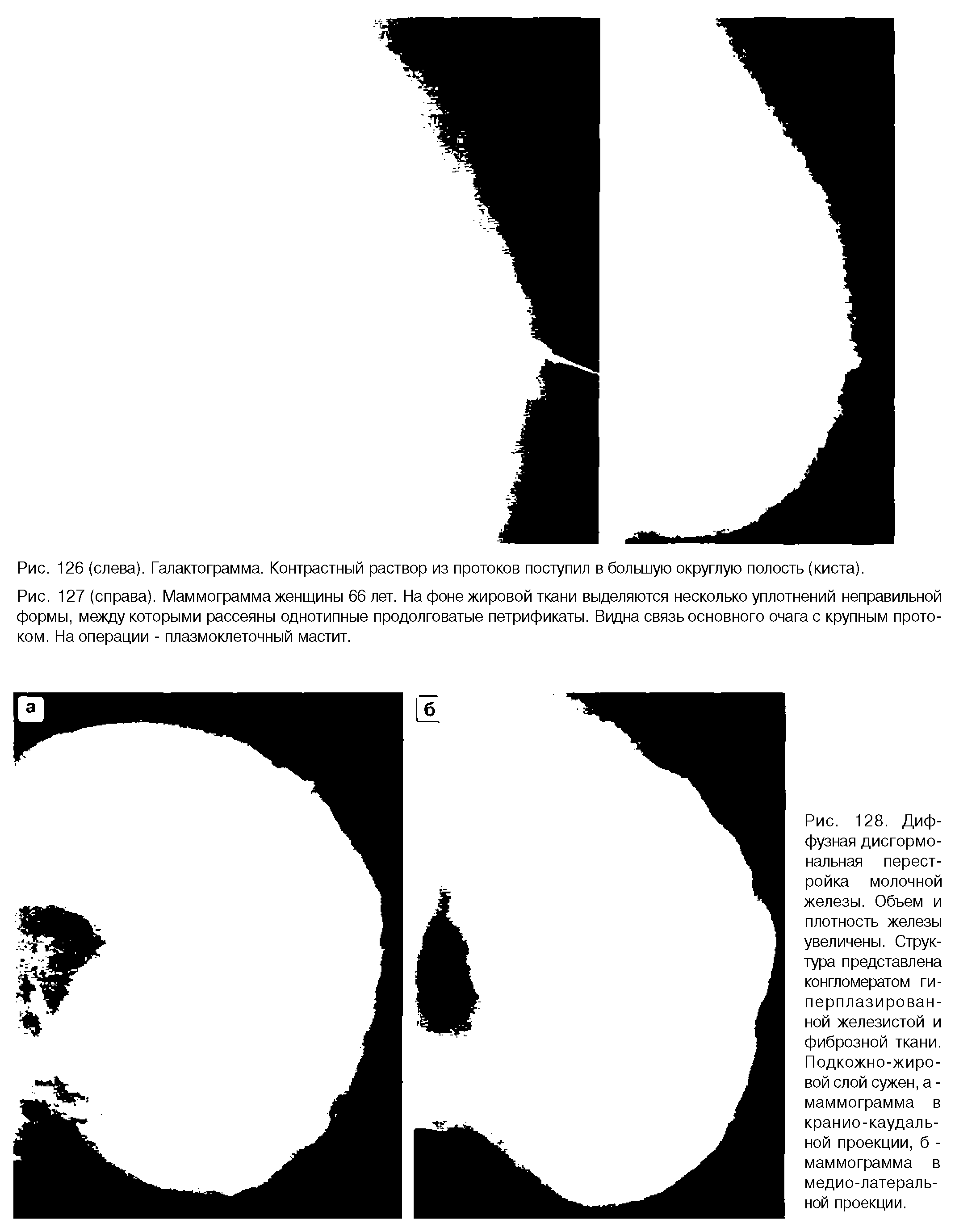 Рис. 128. Диффузная дисгормо-нальная перестройка молочной железы. Объем и плотность железы увеличены. Структура представлена конгломератом гиперплазированной железистой и фиброзной ткани. Подкожно-жировой слой сужен, а -маммограмма в кранио-каудальной проекции, б -маммограмма в медио-латераль-ной проекции.