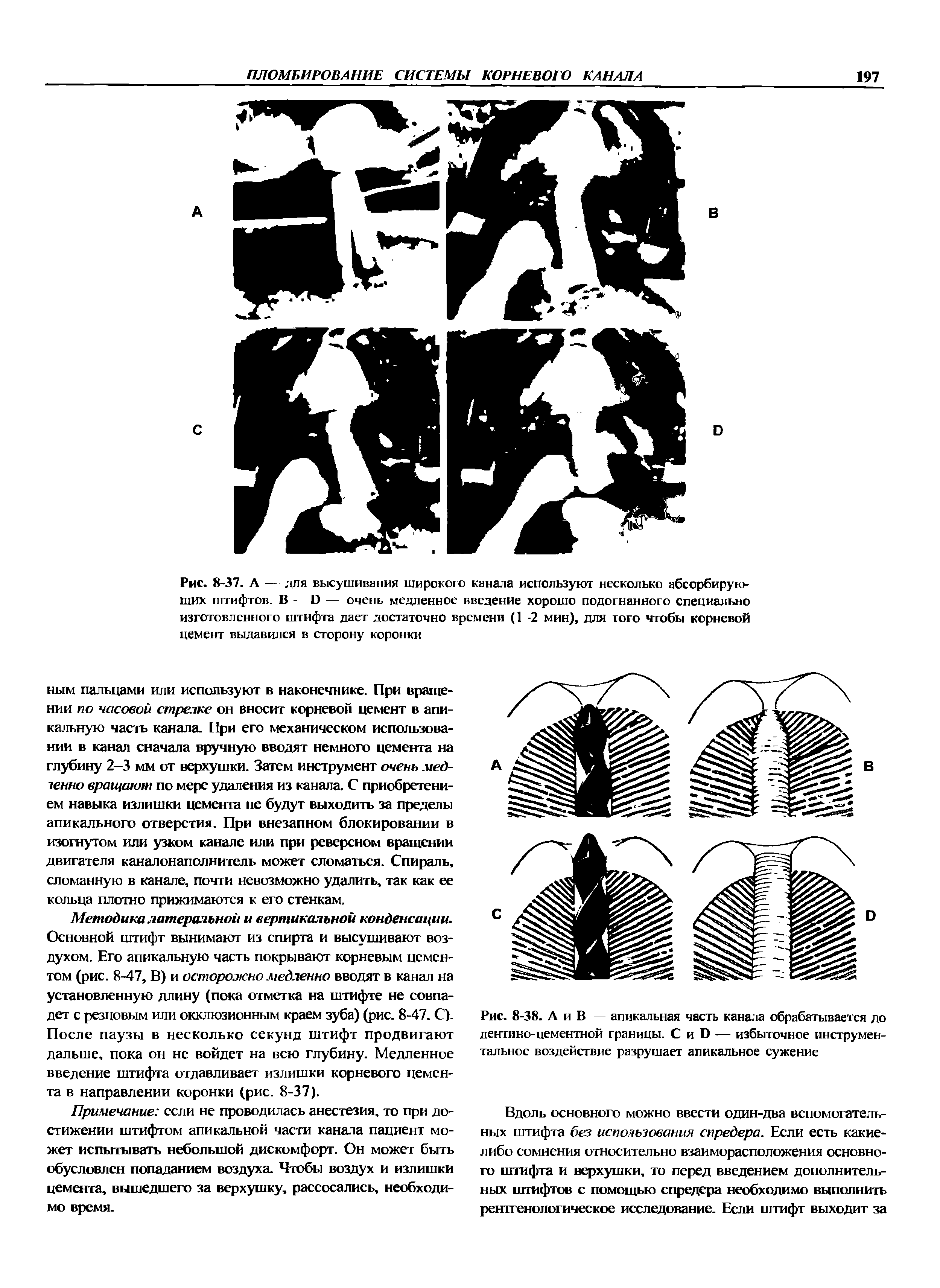 Рис. 8-38. А и В апикальная часть канала обрабатывается до дентино-цементной границы. С и Б — избыточное инструментальное воздействие разрушает апикальное сужение...