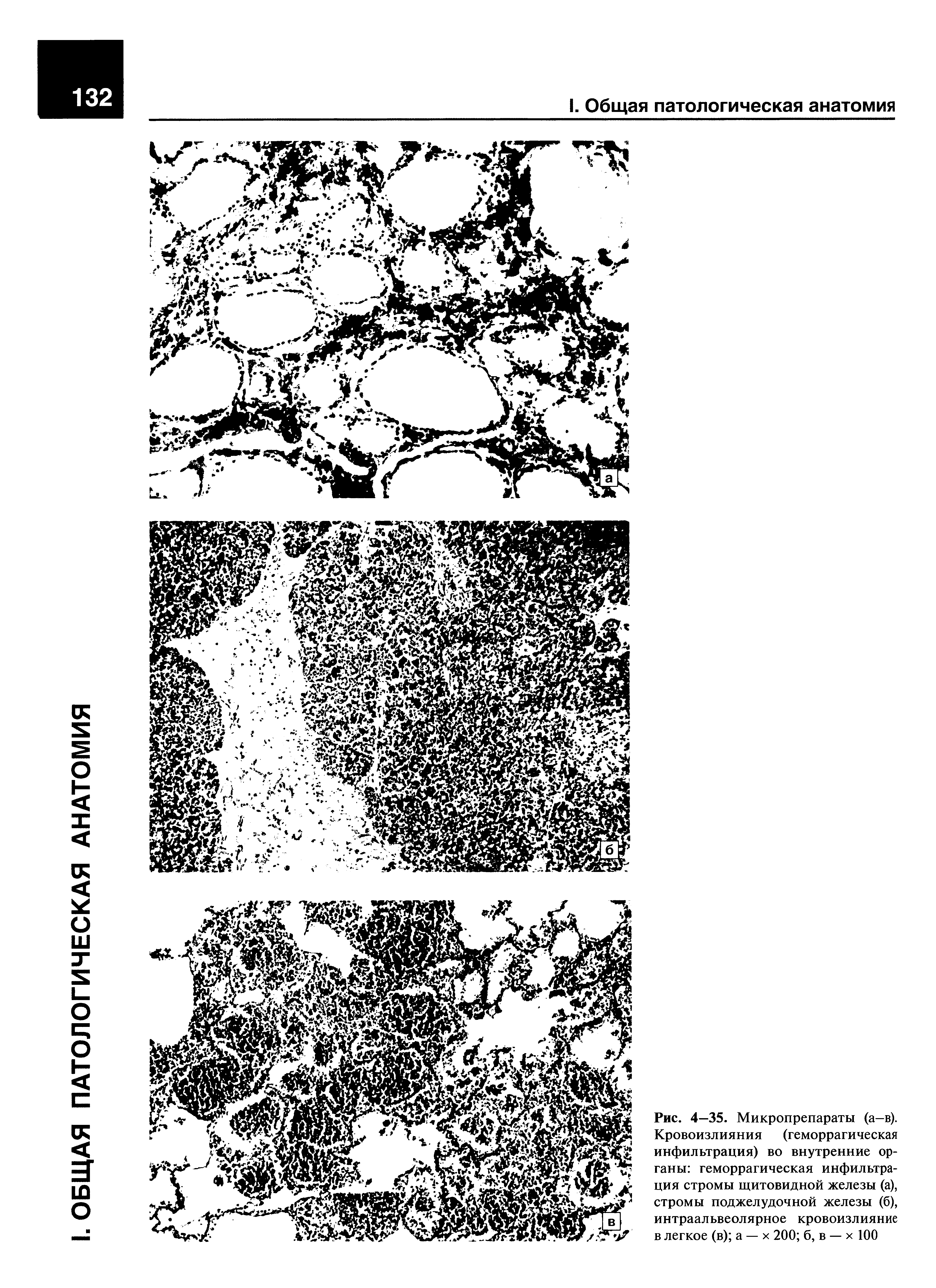 Рис. 4—35. Микропрепараты (а-в). Кровоизлияния (геморрагическая инфильтрация) во внутренние органы геморрагическая инфильтрация стромы щитовидной железы (а), стромы поджелудочной железы (б), интраальвеолярное кровоизлияние в легкое (в) а — х 200 б, в — х 100...