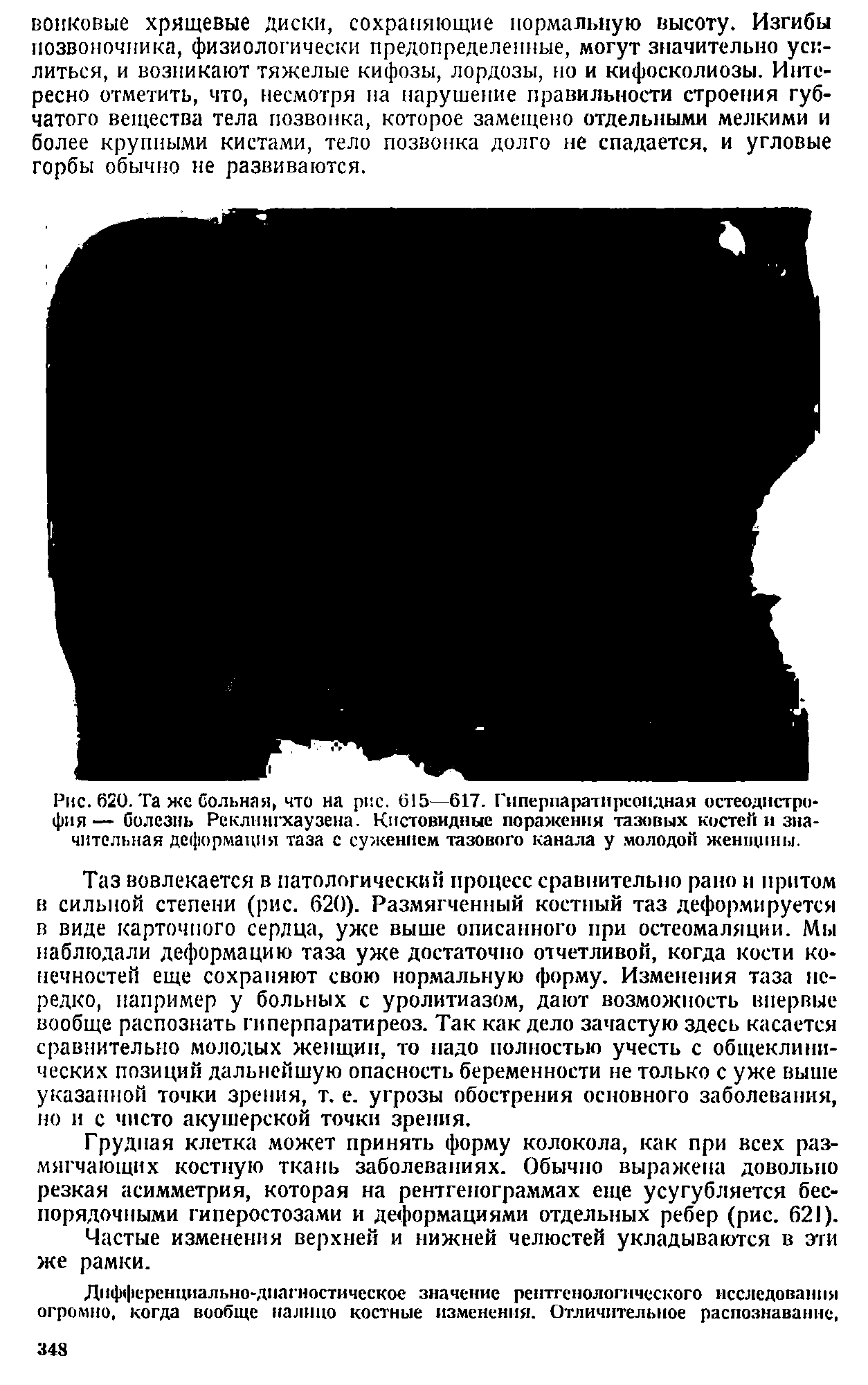 Рис. 620. Та же Сольная, что на рис. 615—617. Гиперпаратиреоидная остеодистро фия— болезнь Реклингхаузена. Кистовидные поражения тазовых костей и зна читальная деформация таза с сужением тазового канала у молодой женщины.