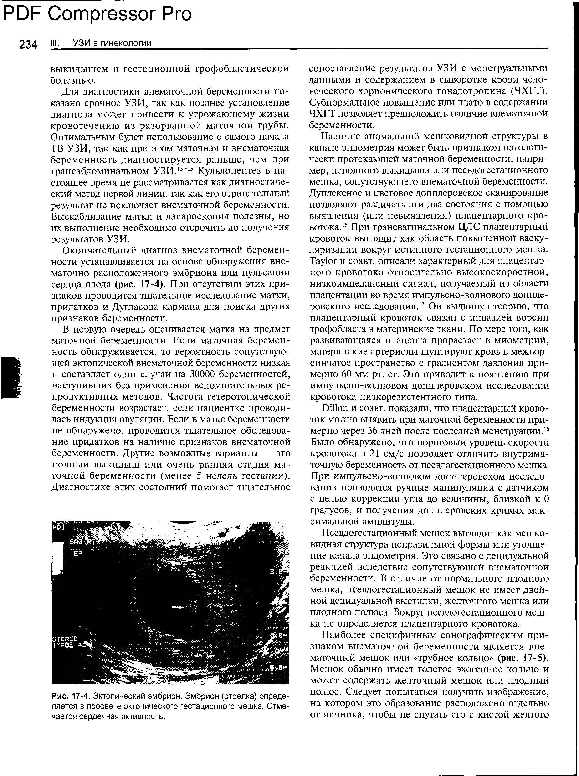 Рис. 17-4. Эктопический эмбрион. Эмбрион (стрелка) определяется в просвете эктопического гестационного мешка. Отмечается сердечная активность.