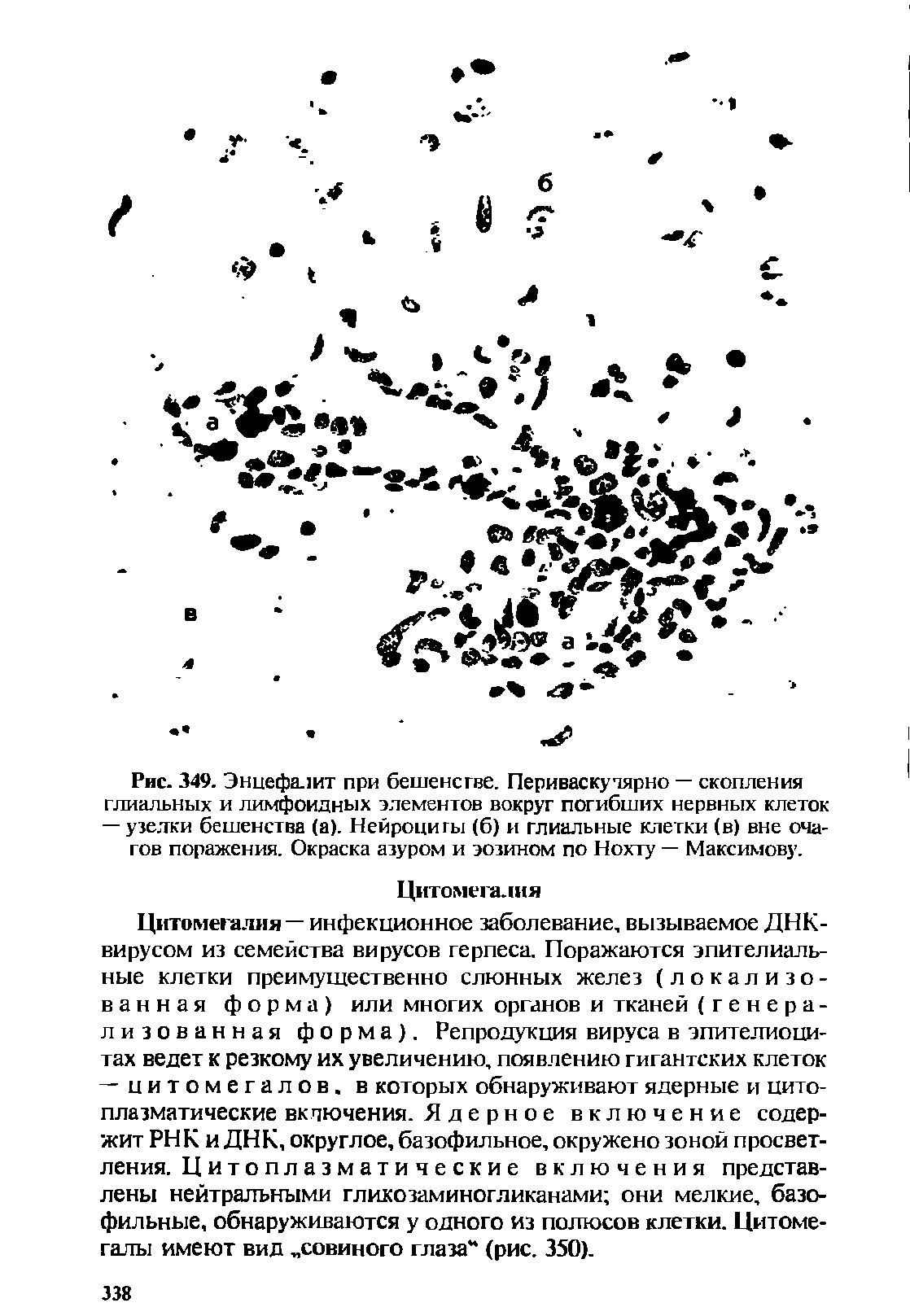 Рис. 349. Энцефалит при бешенстве. Периваскучярно — скопления глиальных и лимфоидных элементов вокруг погибших нервных клеток...