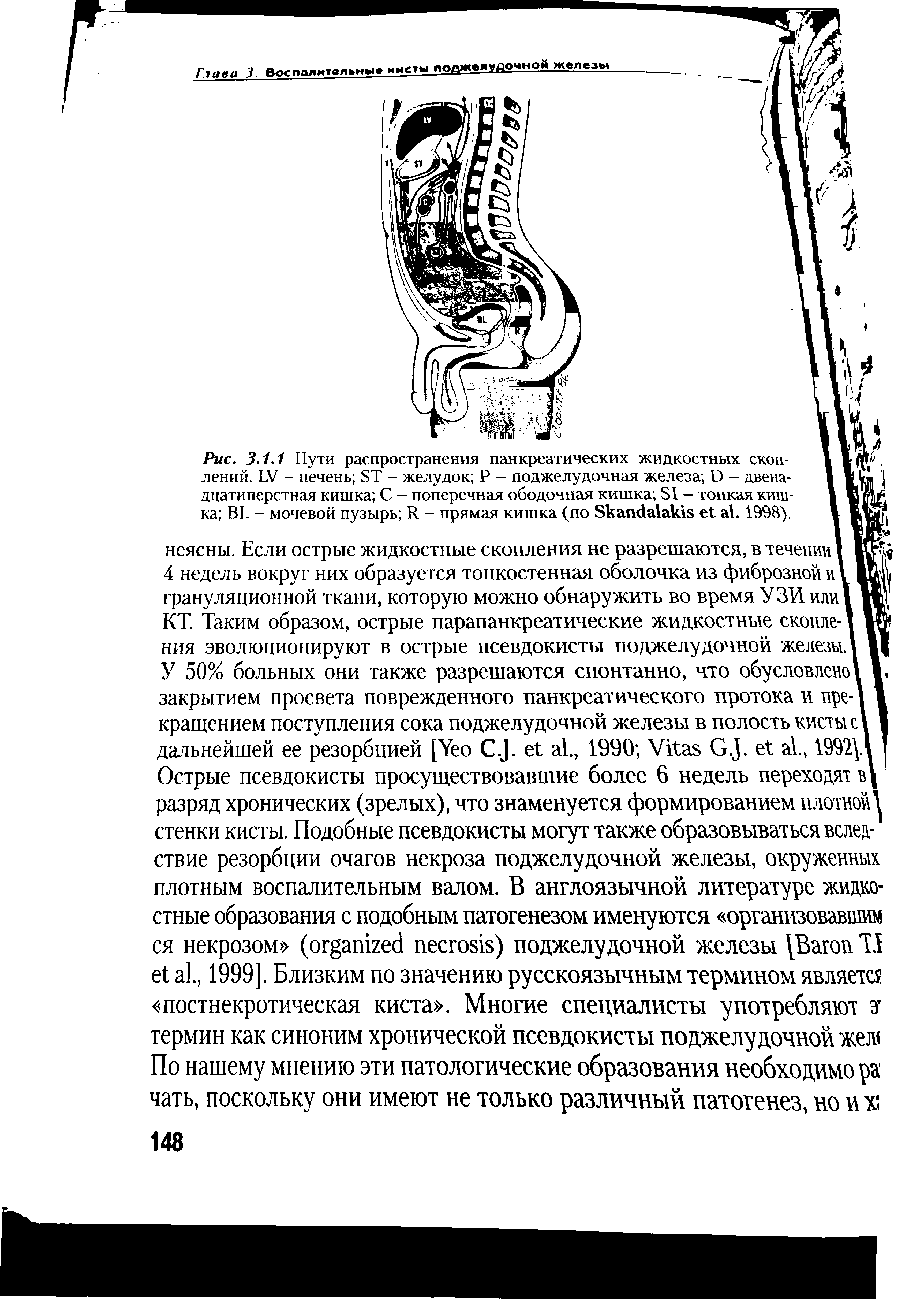 Рис. 3.1.1 Пути распространения панкреатических жидкостных скоп- I лений. LV - печень ST - желудок Р - поджелудочная железа D - двена- I V L дцатиперстная кишка С - поперечная ободочная кишка SI - тонкая киш- 1 Ш ка BL - мочевой пузырь R - прямая кишка (по S . 1998). 1 Д...