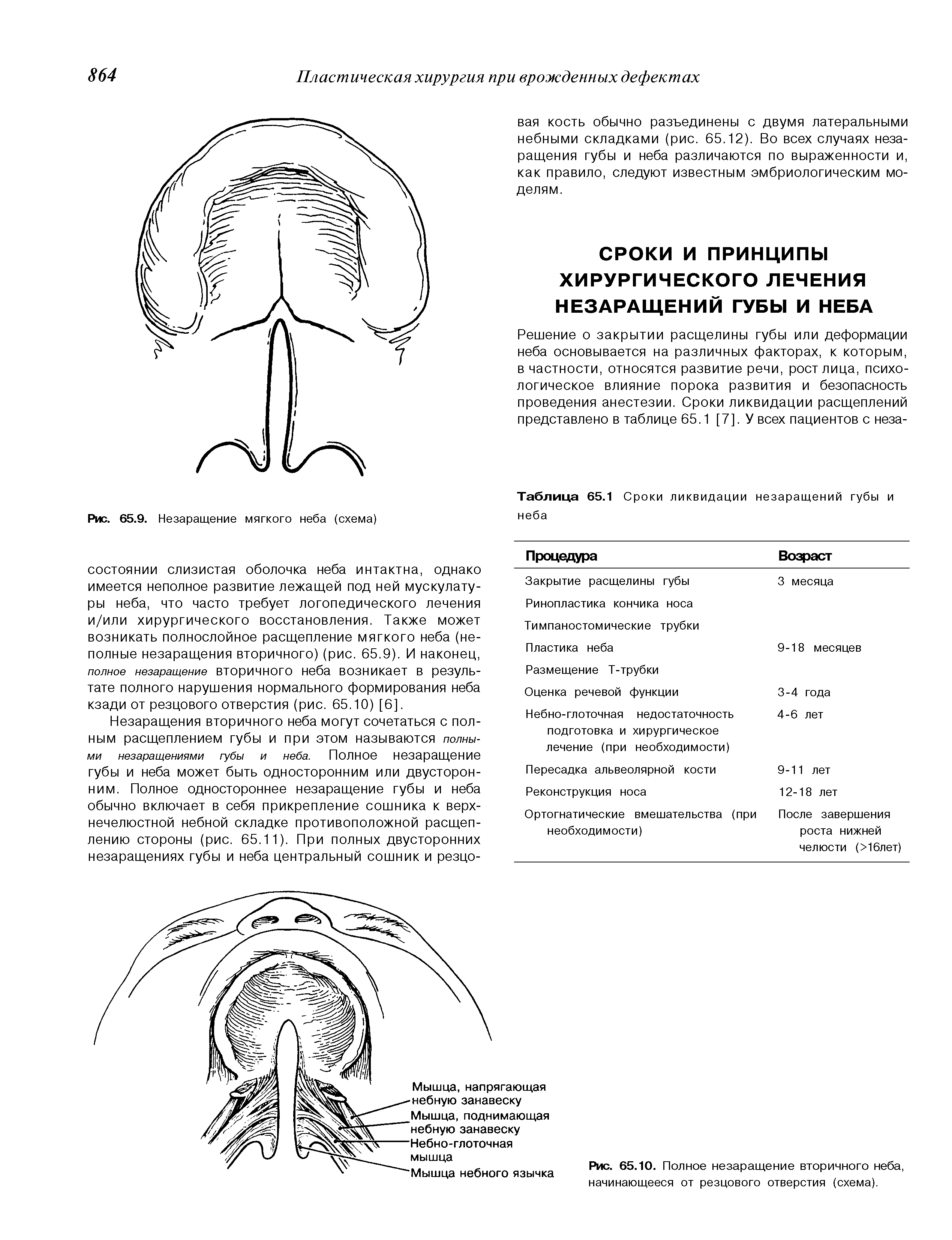 Таблица 65.1 Сроки ликвидации незаращений губы и неба...