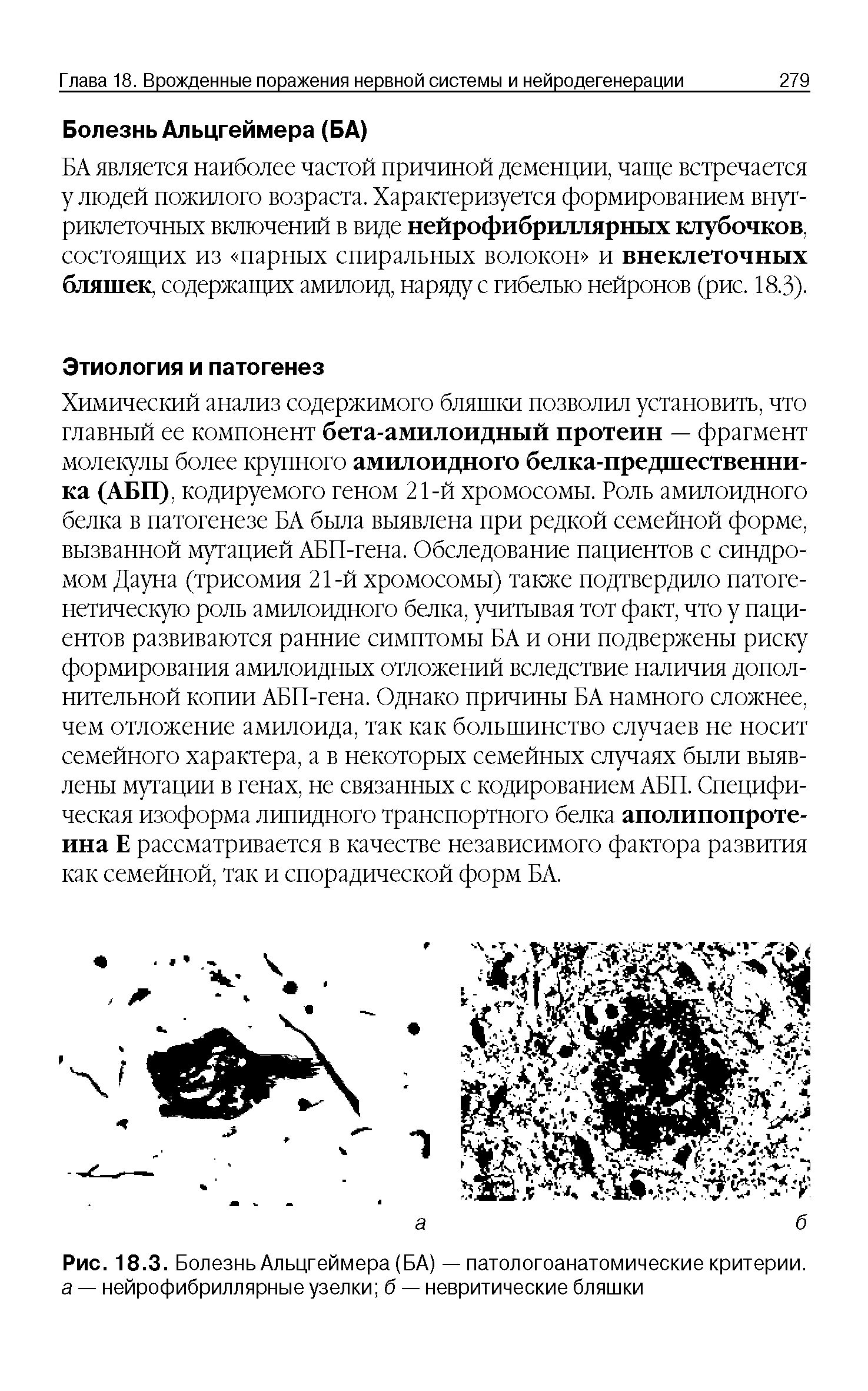 Рис. 18.3. Болезнь Альцгеймера (БА) — патологоанатомические критерии, а — нейрофибриллярные узелки б — невритические бляшки...