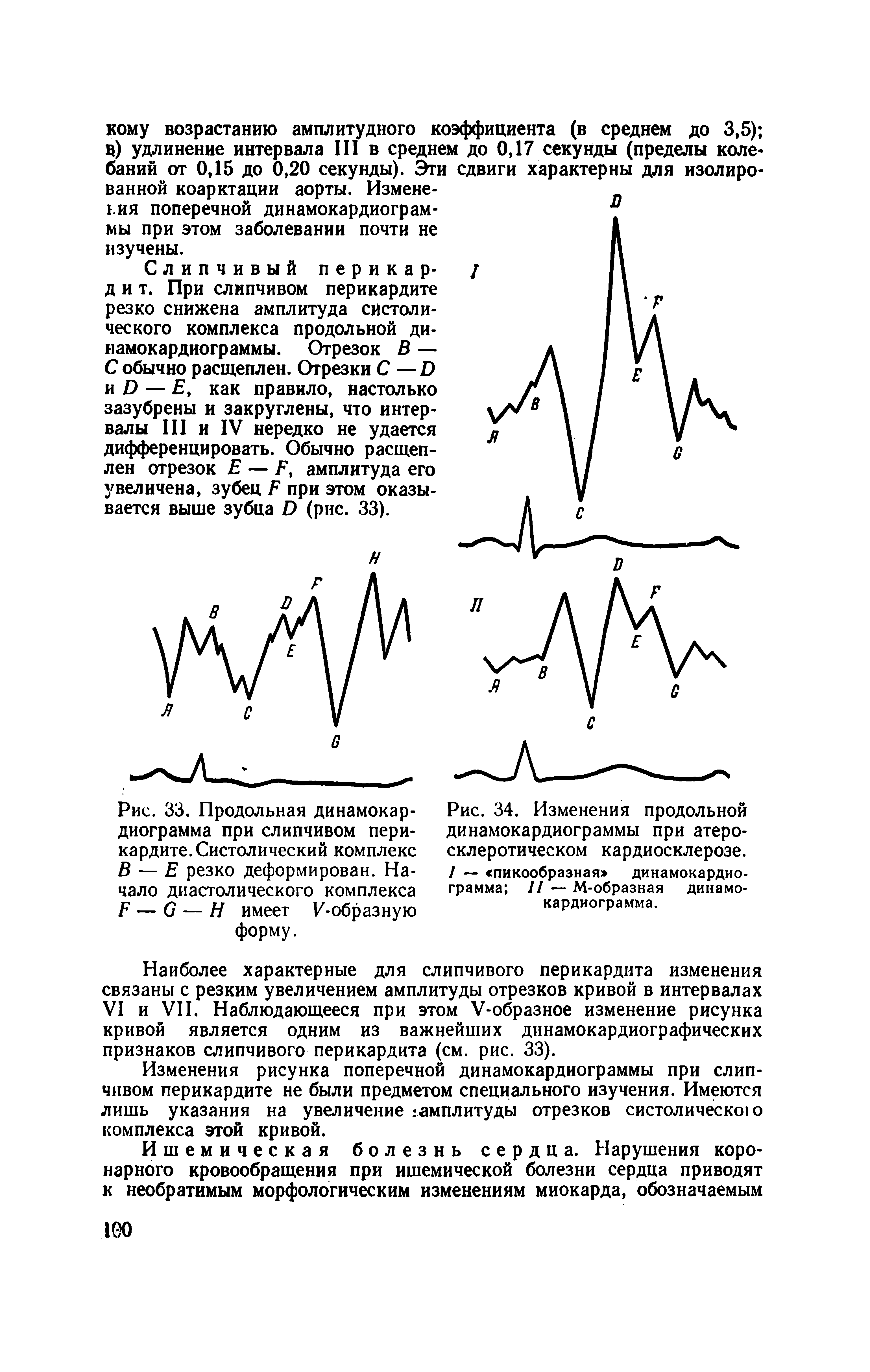 Рис. 34. Изменения продольной динамокардиограммы при атеросклеротическом кардиосклерозе. / — пикообразная> динамокардиограмма II — М-образная динамокардиограмма.