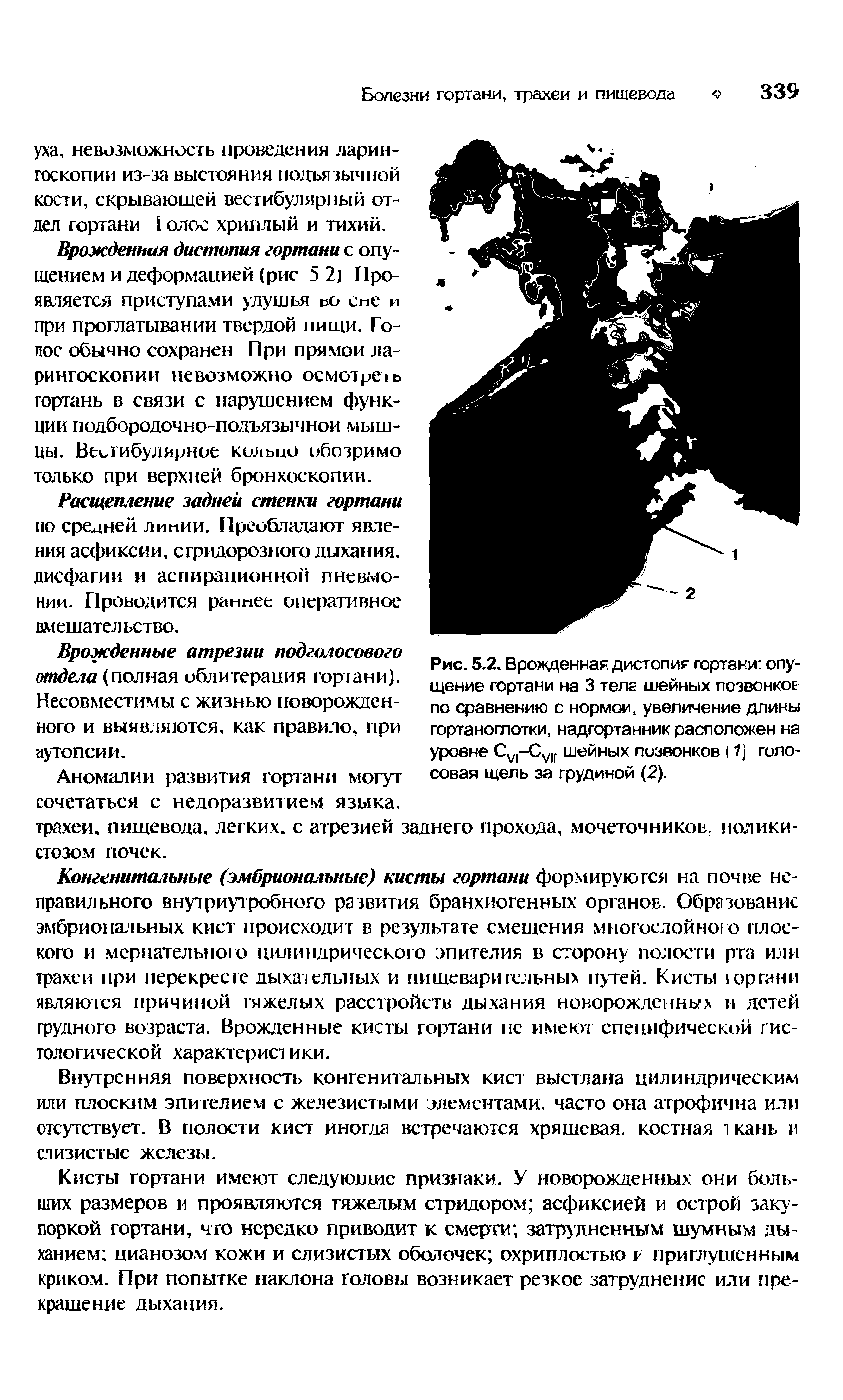 Рис. 5.2. Врожденная дистопия гортани опущение гортани на 3 теле шейных позвонков по сравнению с нормой, увеличение длины гортаноглотки, надгортанник расположен на уровне Су1-Су [ шейных позвонков 11] голосовая щель за грудиной (2).