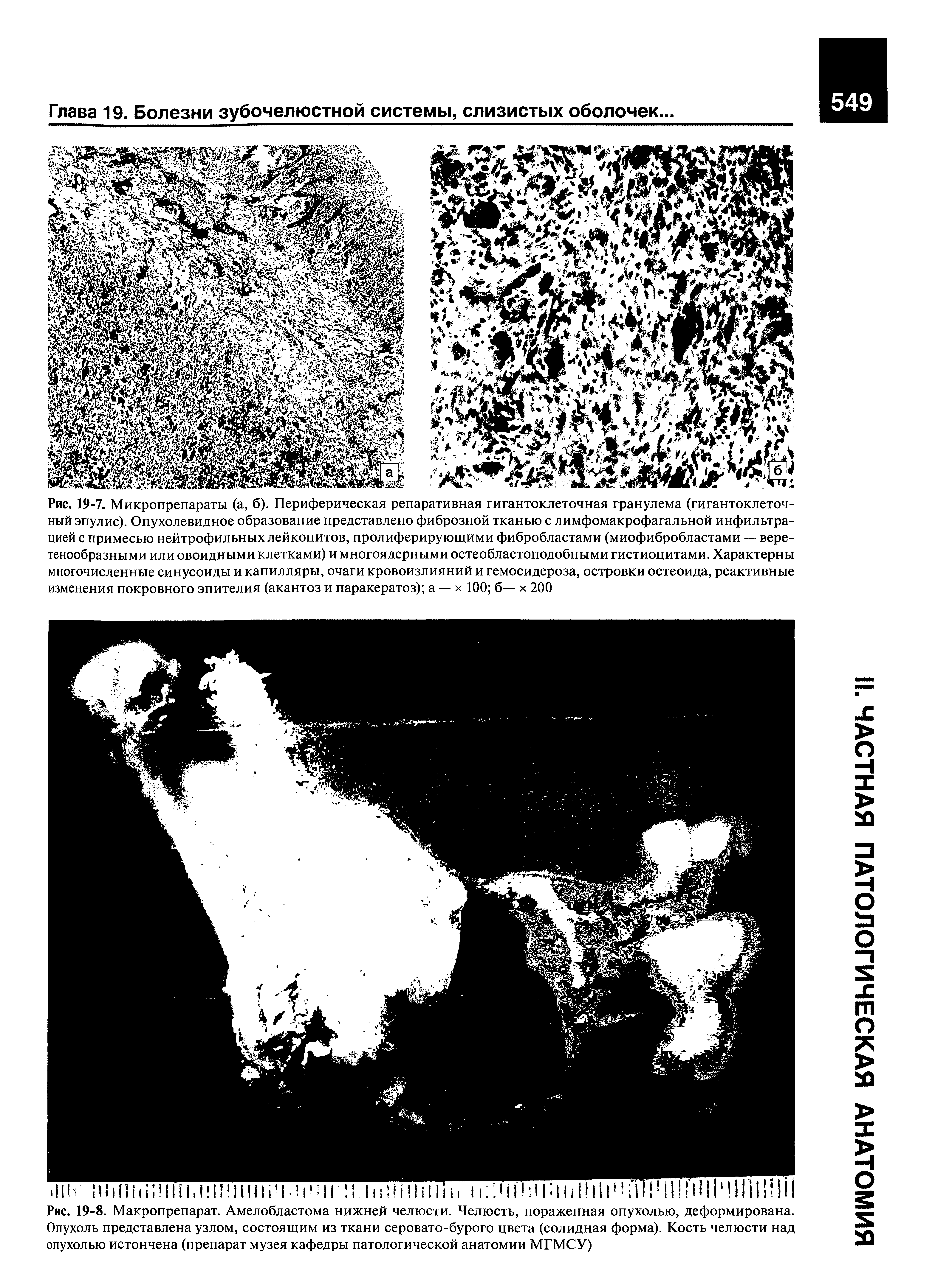 Рис. 19-8. Макропрепарат. Амелобластома нижней челюсти. Челюсть, пораженная опухолью, деформирована. Опухоль представлена узлом, состоящим из ткани серовато-бурого цвета (солидная форма). Кость челюсти над опухолью истончена (препарат музея кафедры патологической анатомии МГМСУ)...