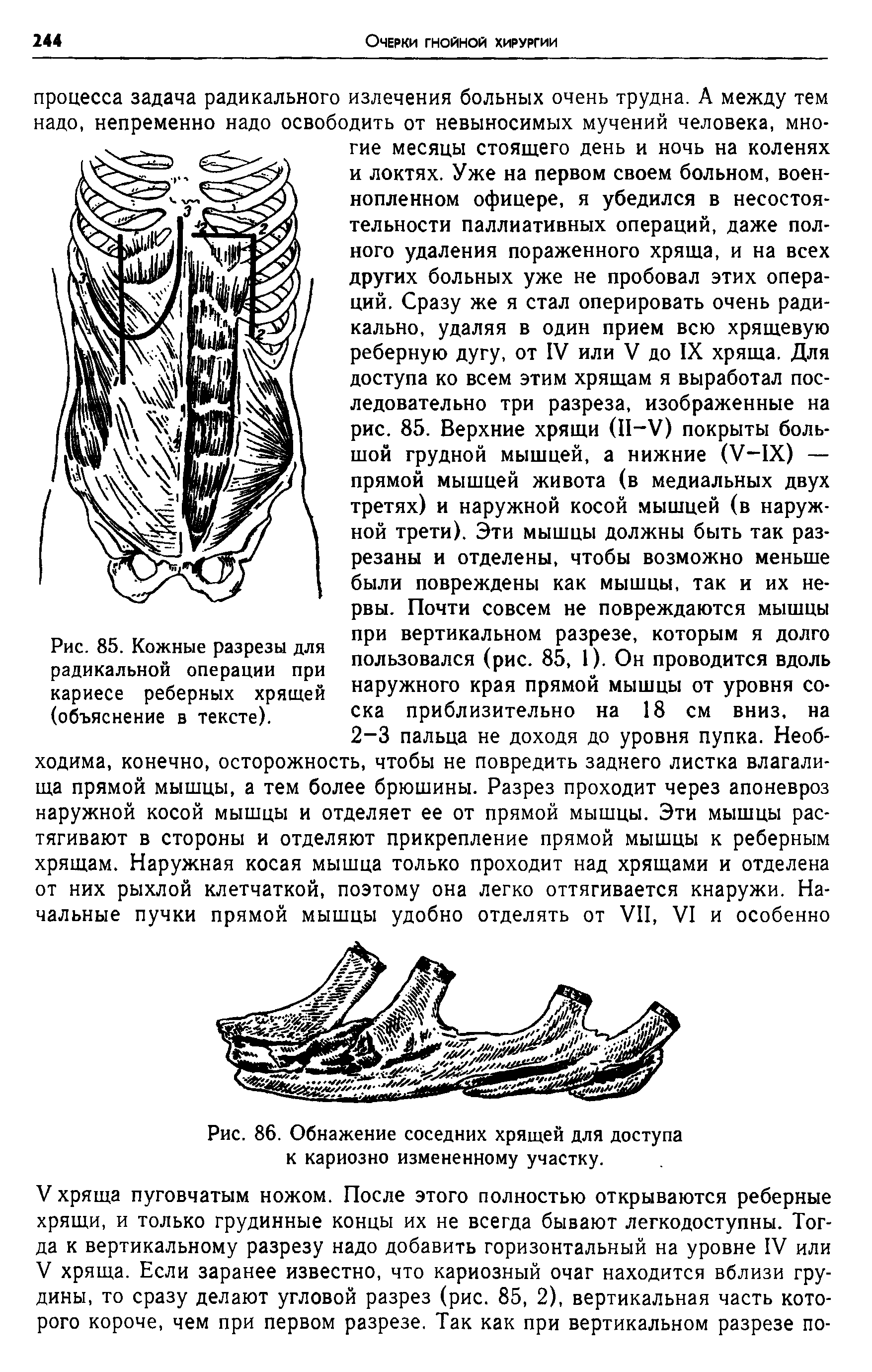 Рис. 86. Обнажение соседних хрящей для доступа к кариозно измененному участку.