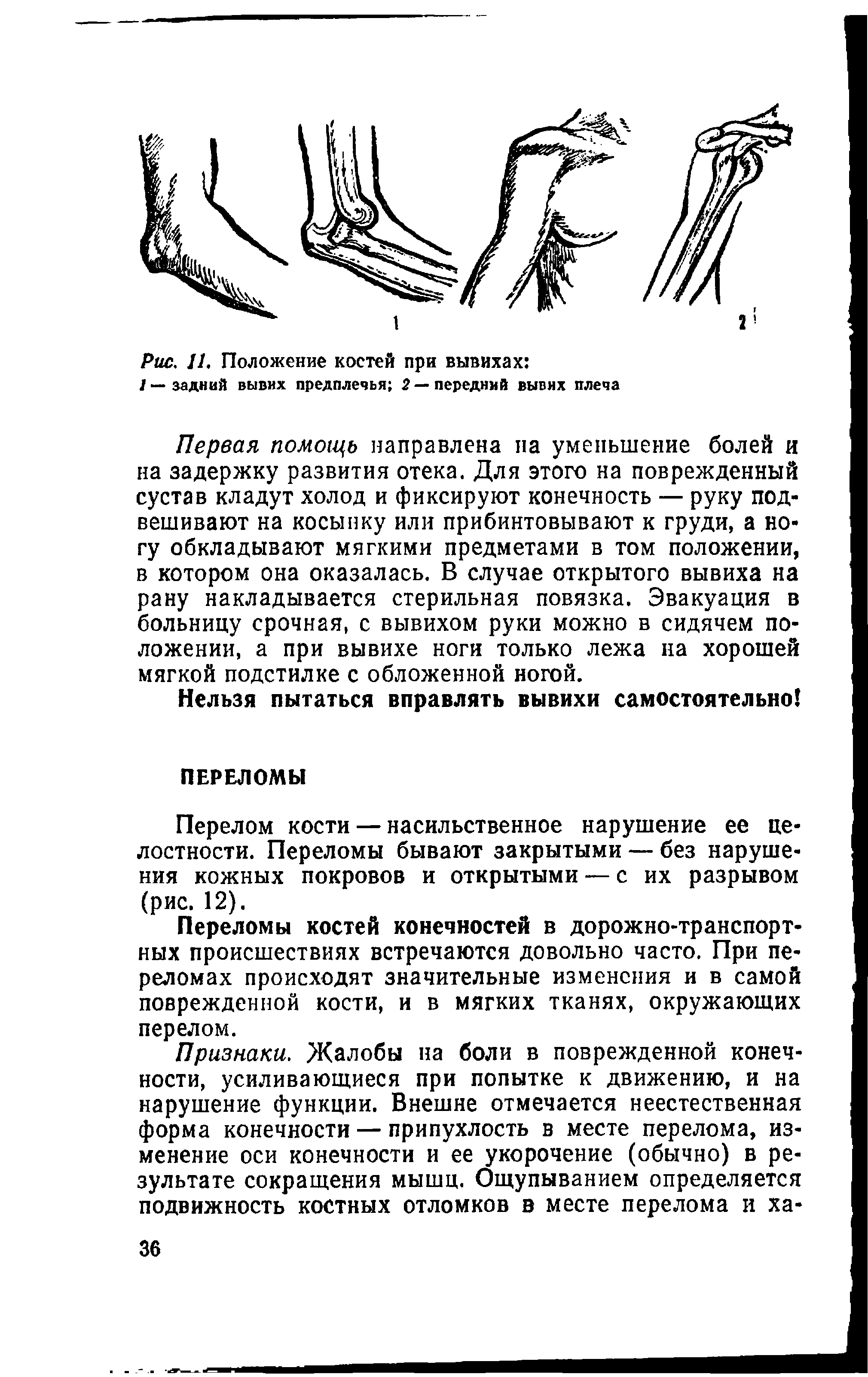 Рис. 11. Положение костей при вывихах /—задний вывих предплечья 2 — передний вывих плеча...