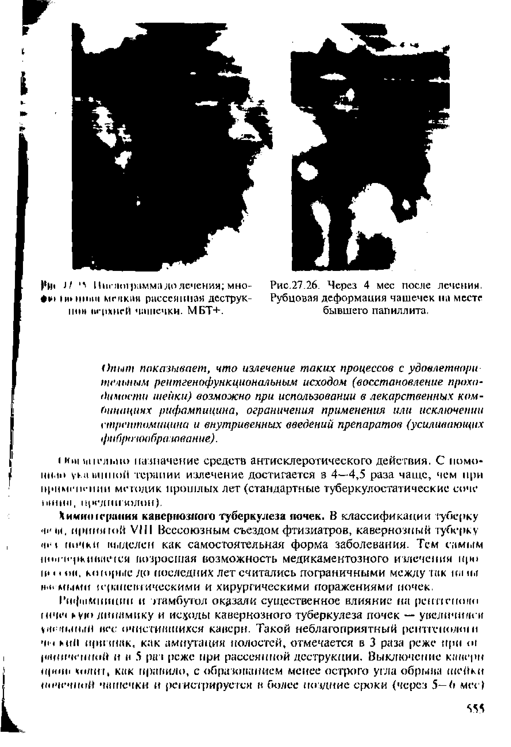 Рис.27.26. Через 4 мес после лечения, Рубцовая деформация чашечек на месте бывшего папиллита.