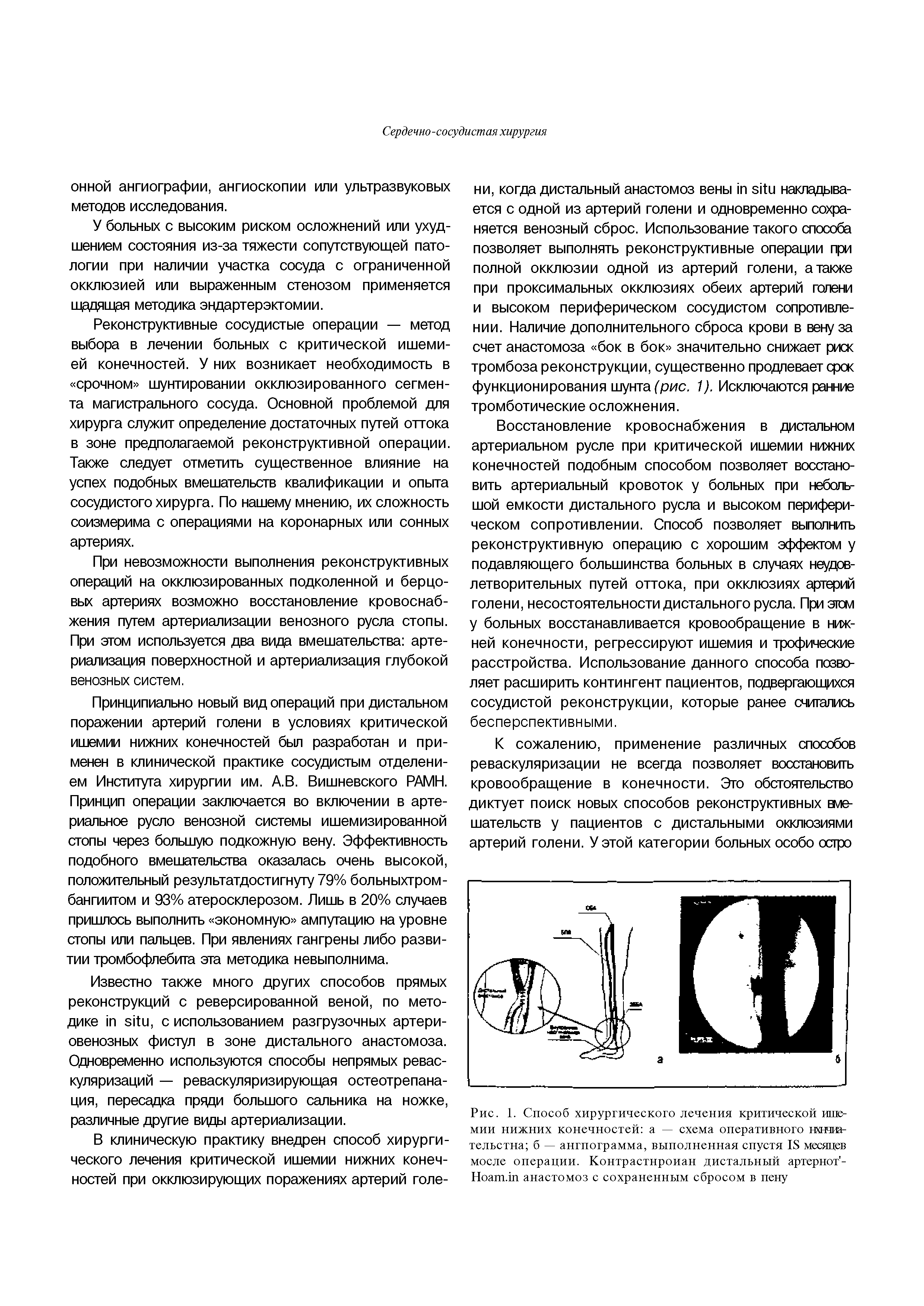 Рис. 1. Способ хирургического лечения критической ишемии нижних конечностей а — схема оперативного нхнчиа-тельстна б — ангиограмма, выполненная спустя К месяцев мосле операции. Контрастнроиан дистальный артернот -Ноаш.ш анастомоз с сохраненным сбросом в пену...