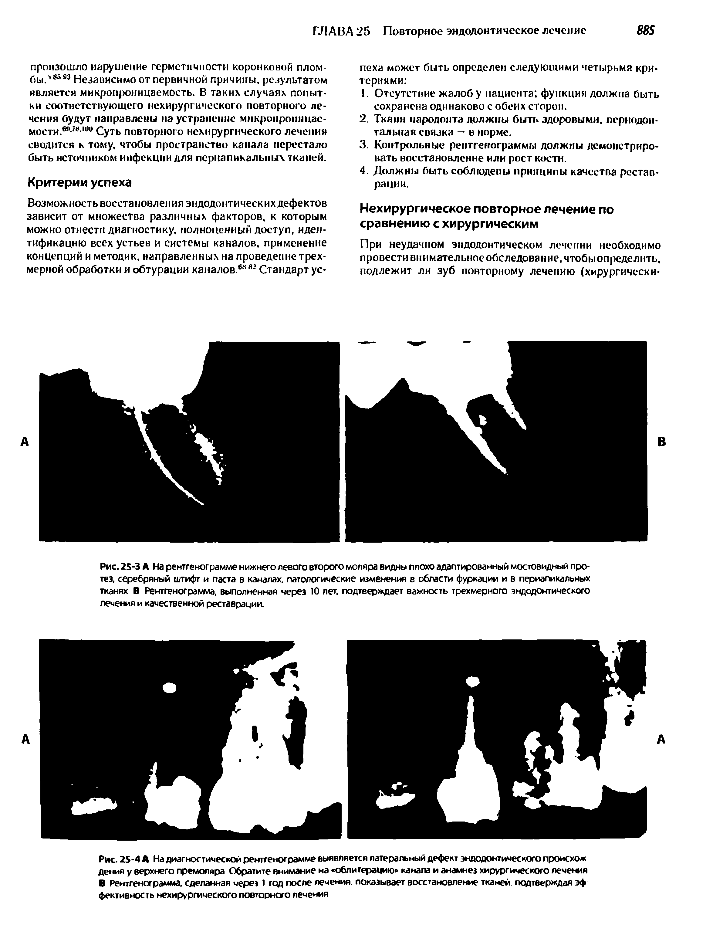 Рис. 25-3 А На рентгенограмме нижнего левого второго моляра видны плохо адаптированный мостовидный протез. серебряный штифт и паста в каналах, патологические изменения в области фуркации и в периапикальных тканях В Рентгенограмма, выполненная через 10 лет, подтверждает важность трехмерного эндодонтического лечения и качественной реставрации.