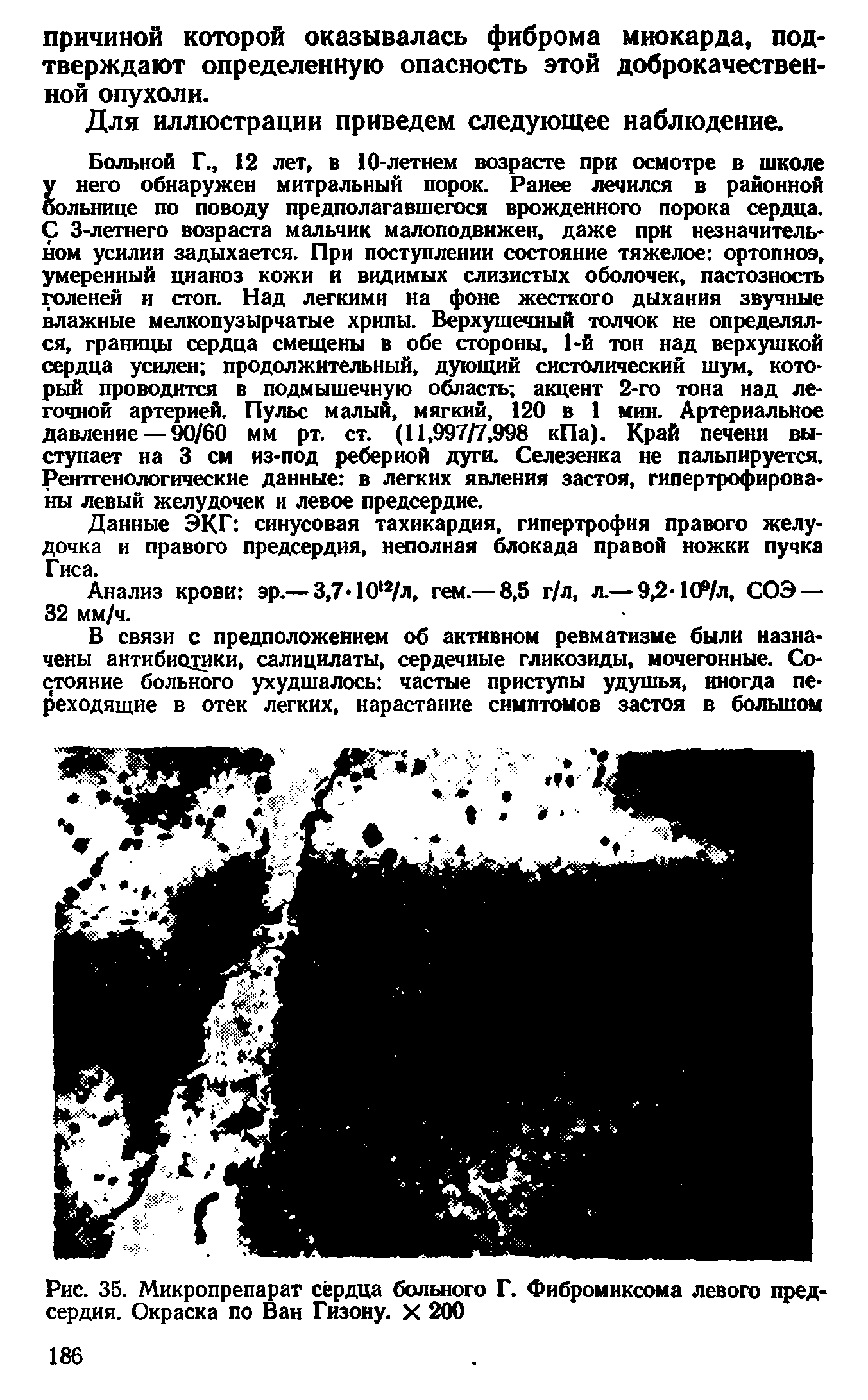 Рис. 35. Микропрепарат сердца больного Г. Фибромиксома левого предсердия. Окраска по Ван Гизону. X 200...