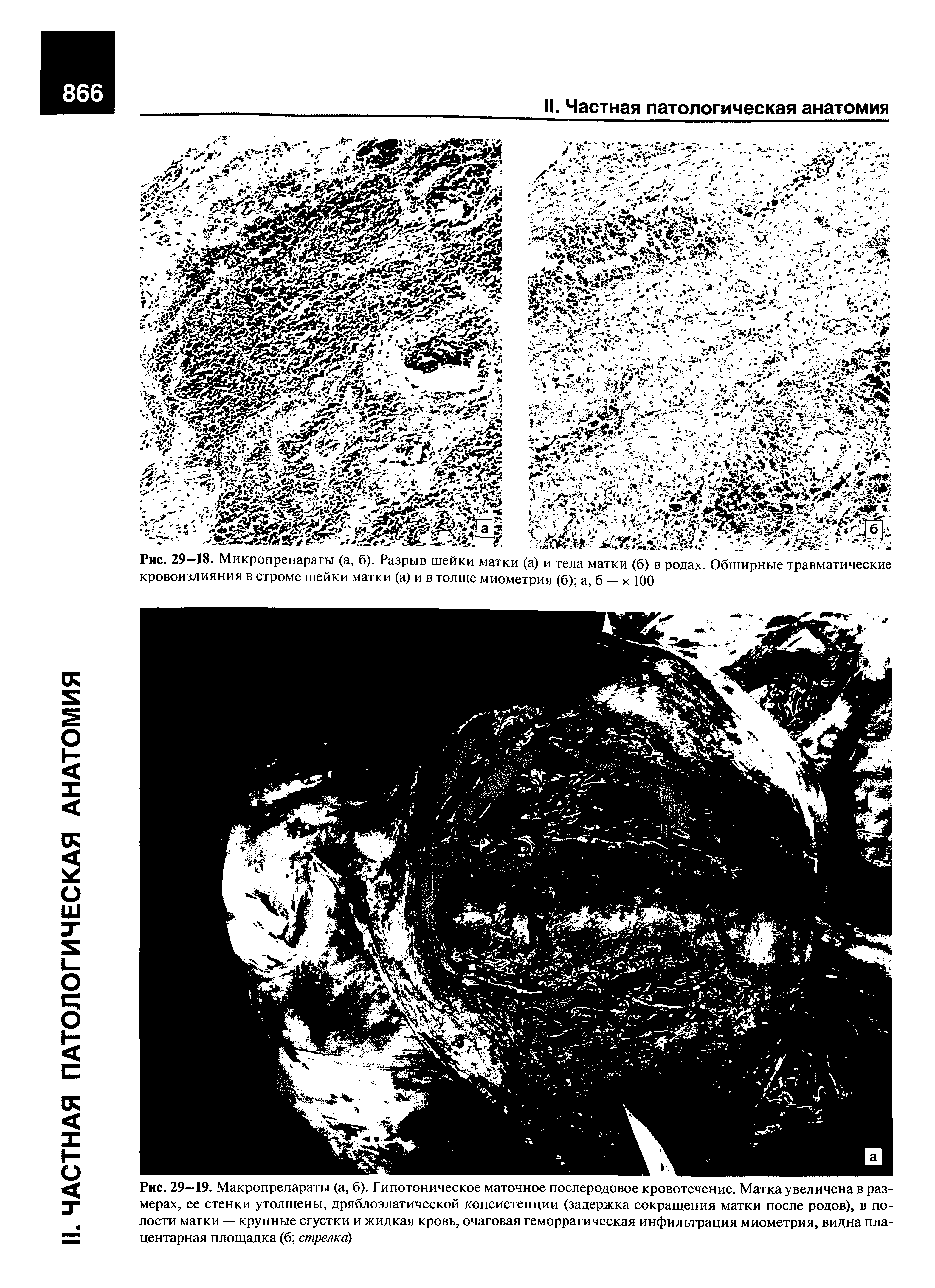 Рис. 29—18. Микропрепараты (а, б). Разрыв шейки матки (а) и тела матки (б) в родах. Обширные травматические кровоизлияния в строме шейки матки (а) и в толще миометрия (б) а, б — х 100...