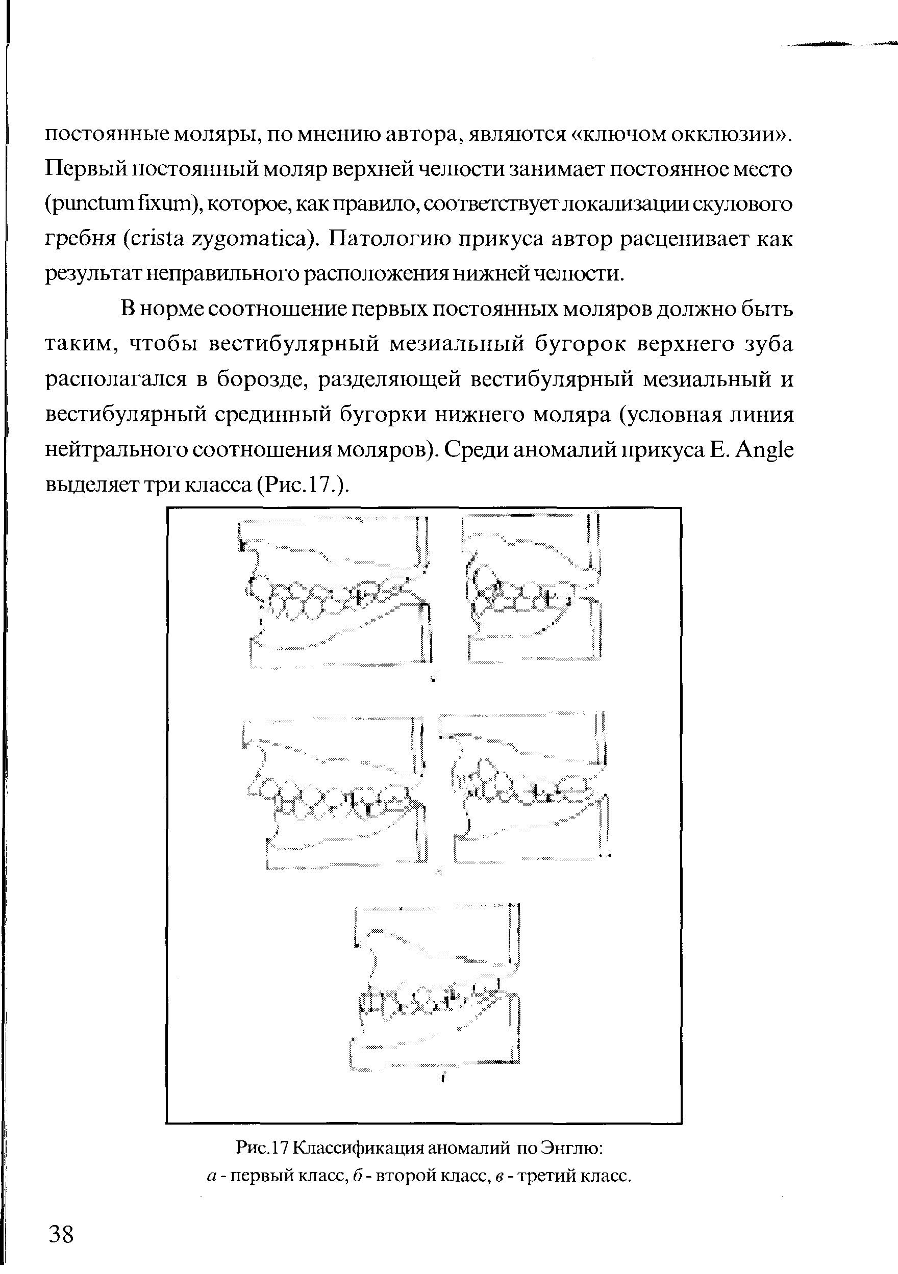 Рис. 17 Классификация аномалий по Энглю а - первый класс, б - второй класс, в - третий класс.