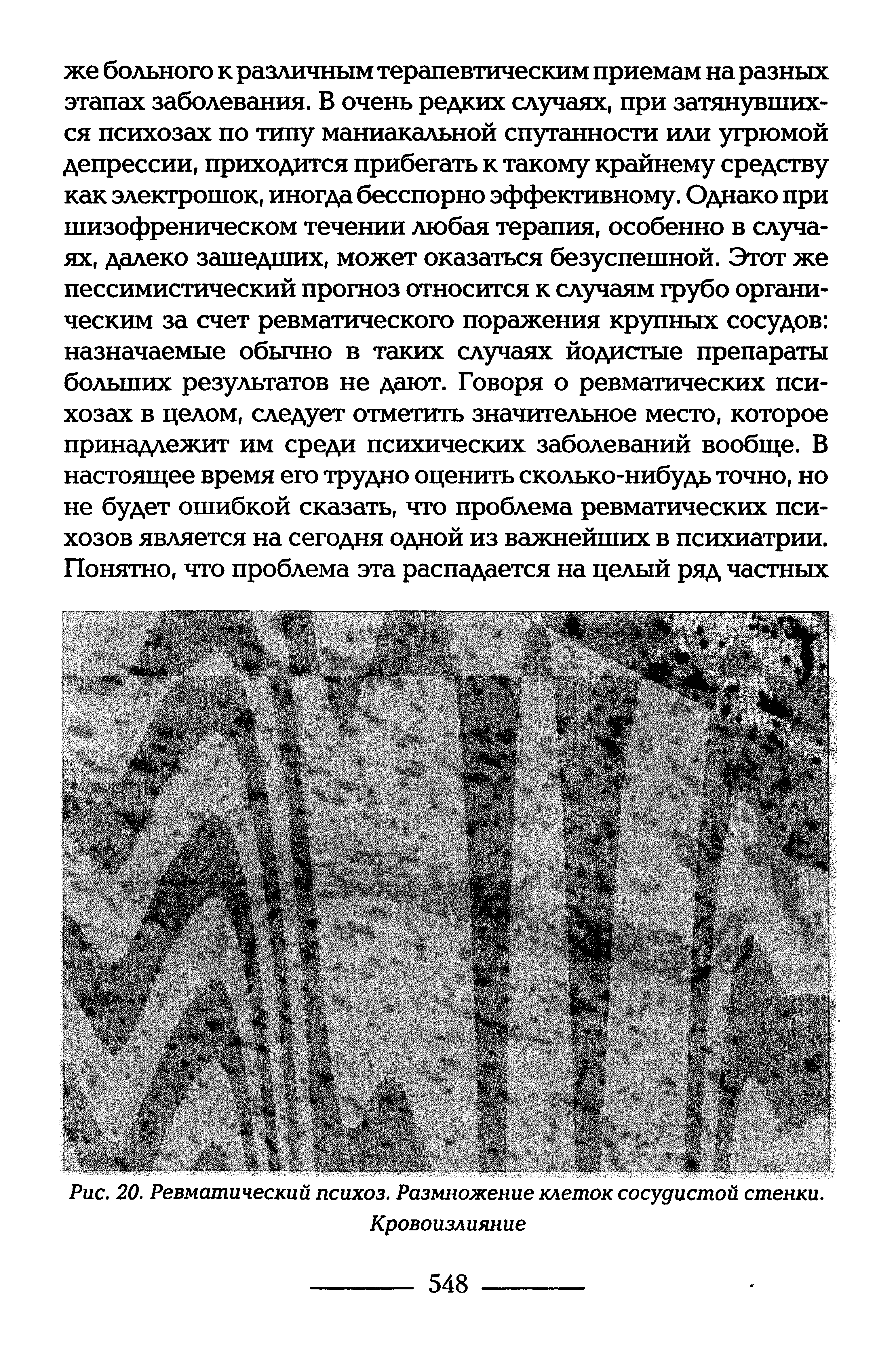 Рис. 20. Ревматический психоз. Размножение клеток сосудистой стенки. Кровоизлияние...