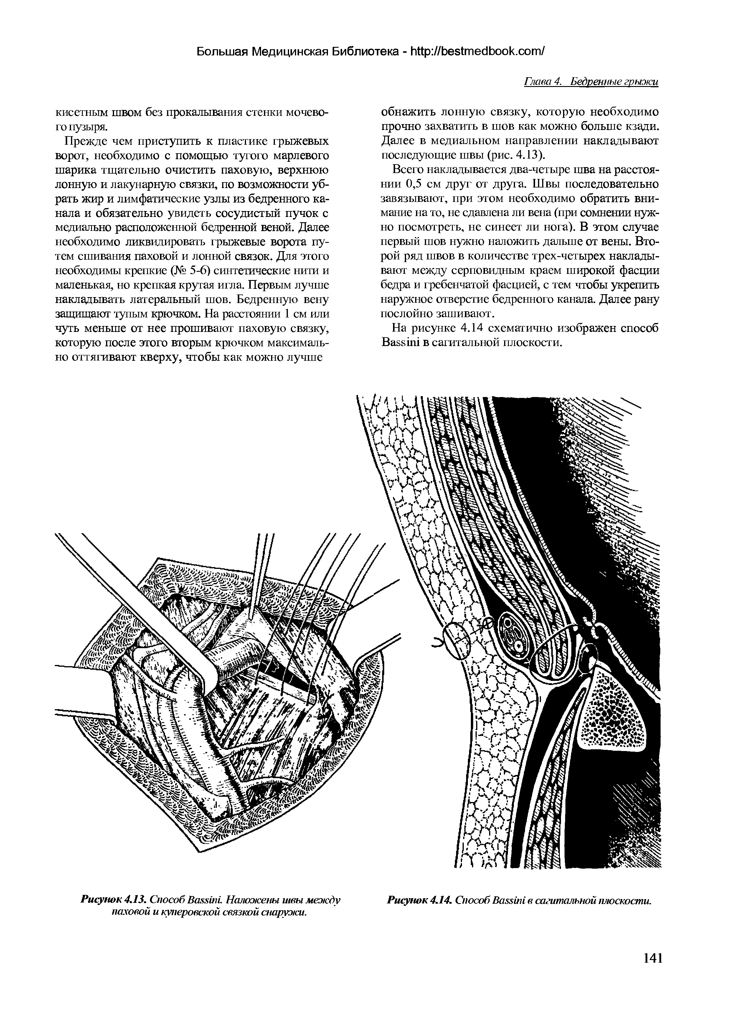 Рисунок 4.13. Способ Ваххйа Наложены швы между паховой и куперовской связкой снаружи.