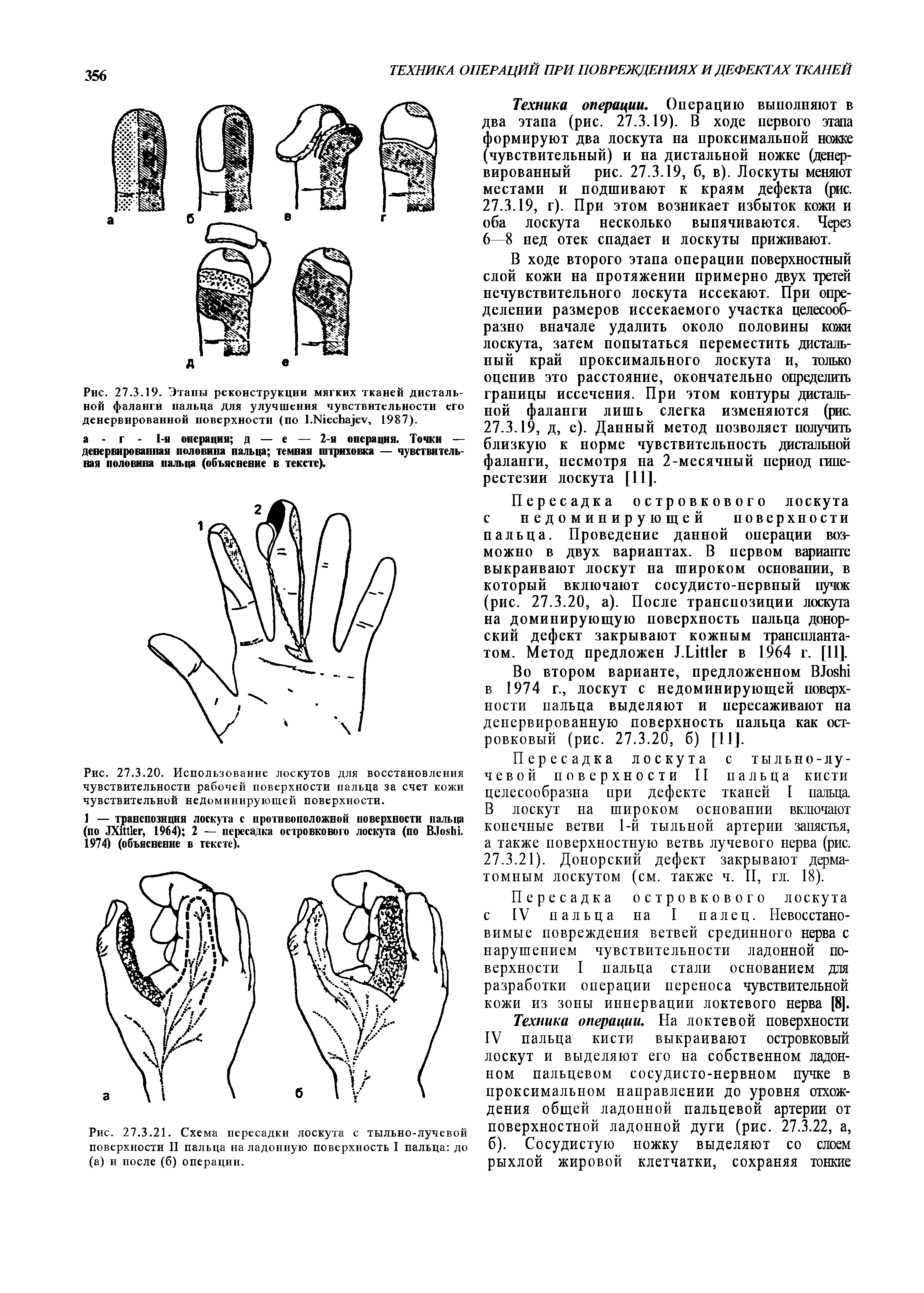 Рис. 27.3.21. Схема пересадки лоскута с тыльно-лучевой поверхности II пальца на ладонную поверхность I пальца до (а) и после (б) операции.