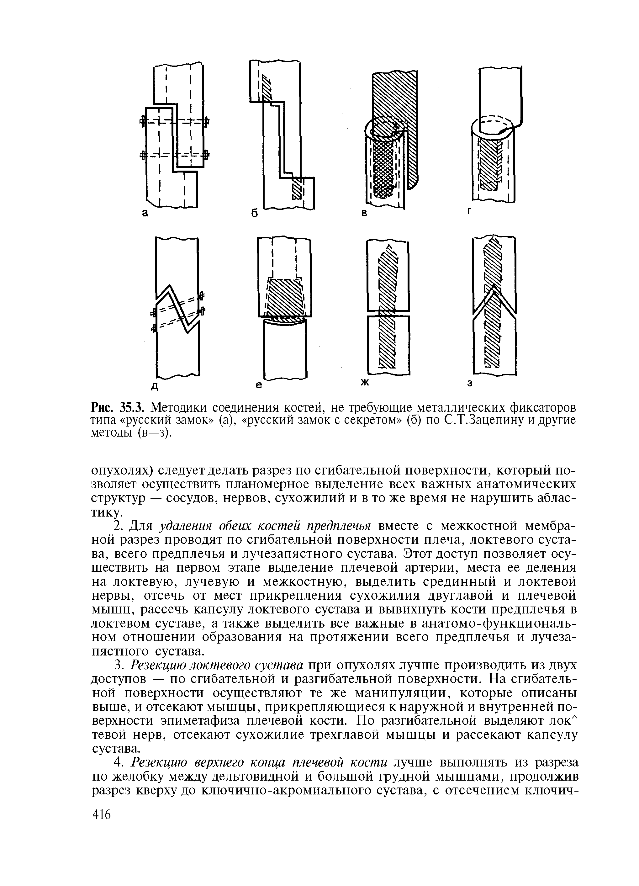 Рис. 35.3. Методики соединения костей, не требующие металлических фиксаторов типа русский замок (а), русский замок с секретом (б) по С.Т.Зацепину и другие методы (в—з).