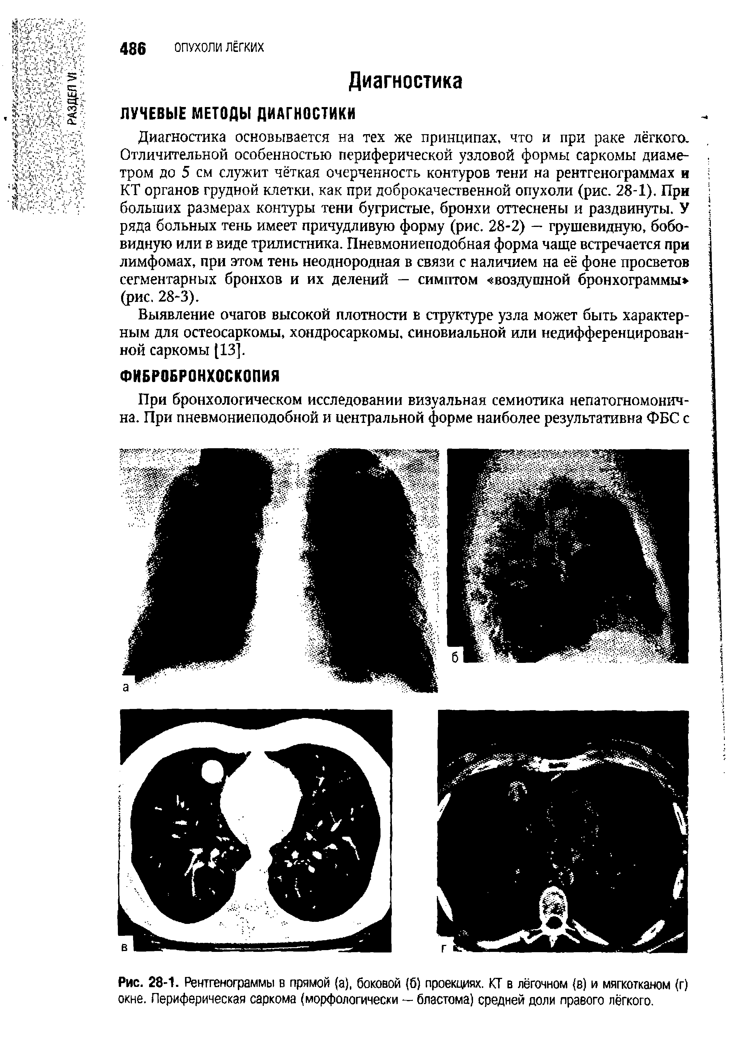 Рис. 28-1. Рентгенограммы в прямой (а), боковой б) проекциях. КТ в лёгочном (в) и мягкотканом (г) окне. Периферическая саркома (морфологически — бластома) средней доли правого лёгкого.