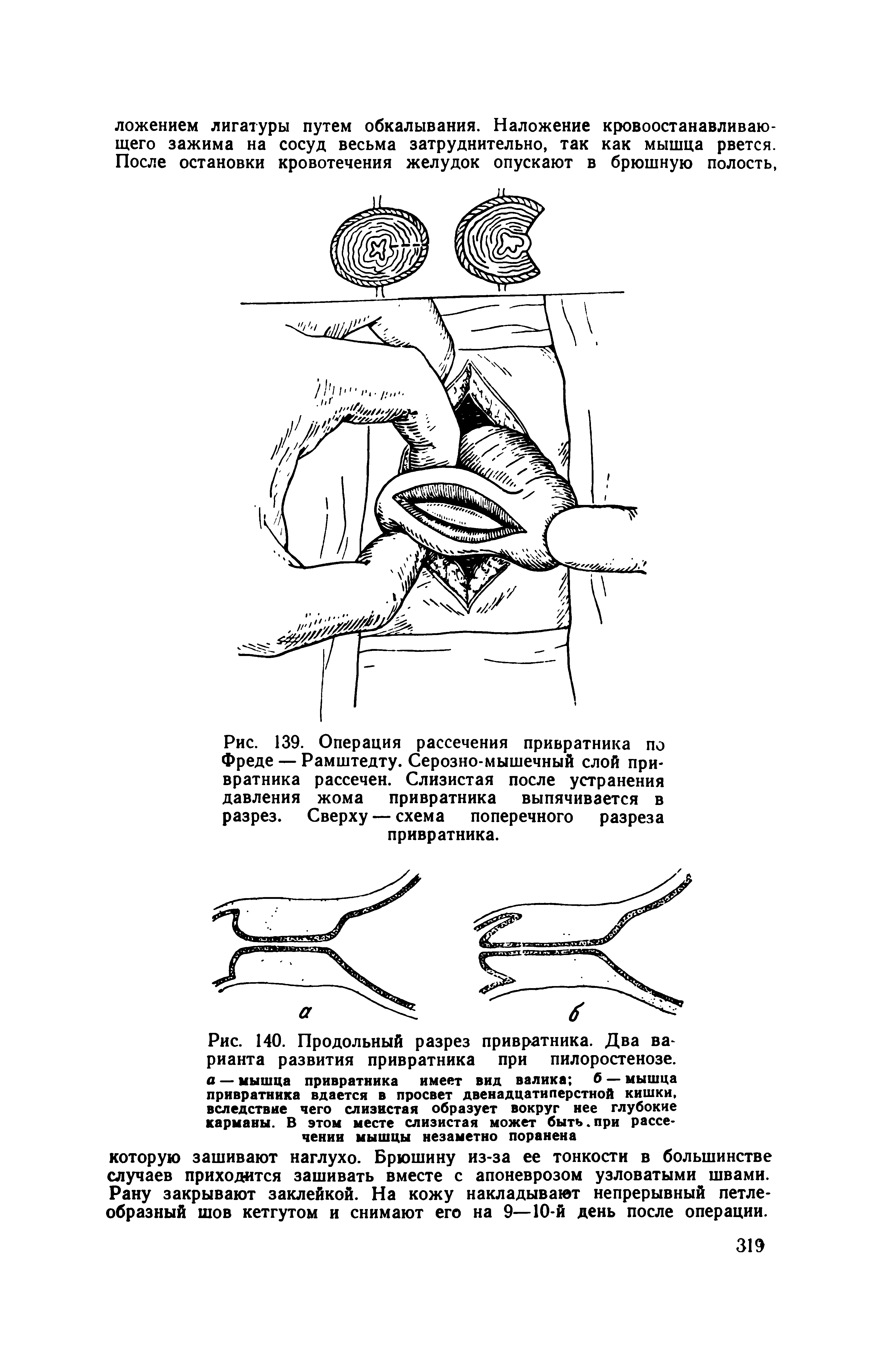 Рис. 139. Операция рассечения привратника по Фреде — Рамштедту. Серозно-мышечный слой привратника рассечен. Слизистая после устранения давления жома привратника выпячивается в разрез. Сверху — схема поперечного разреза привратника.