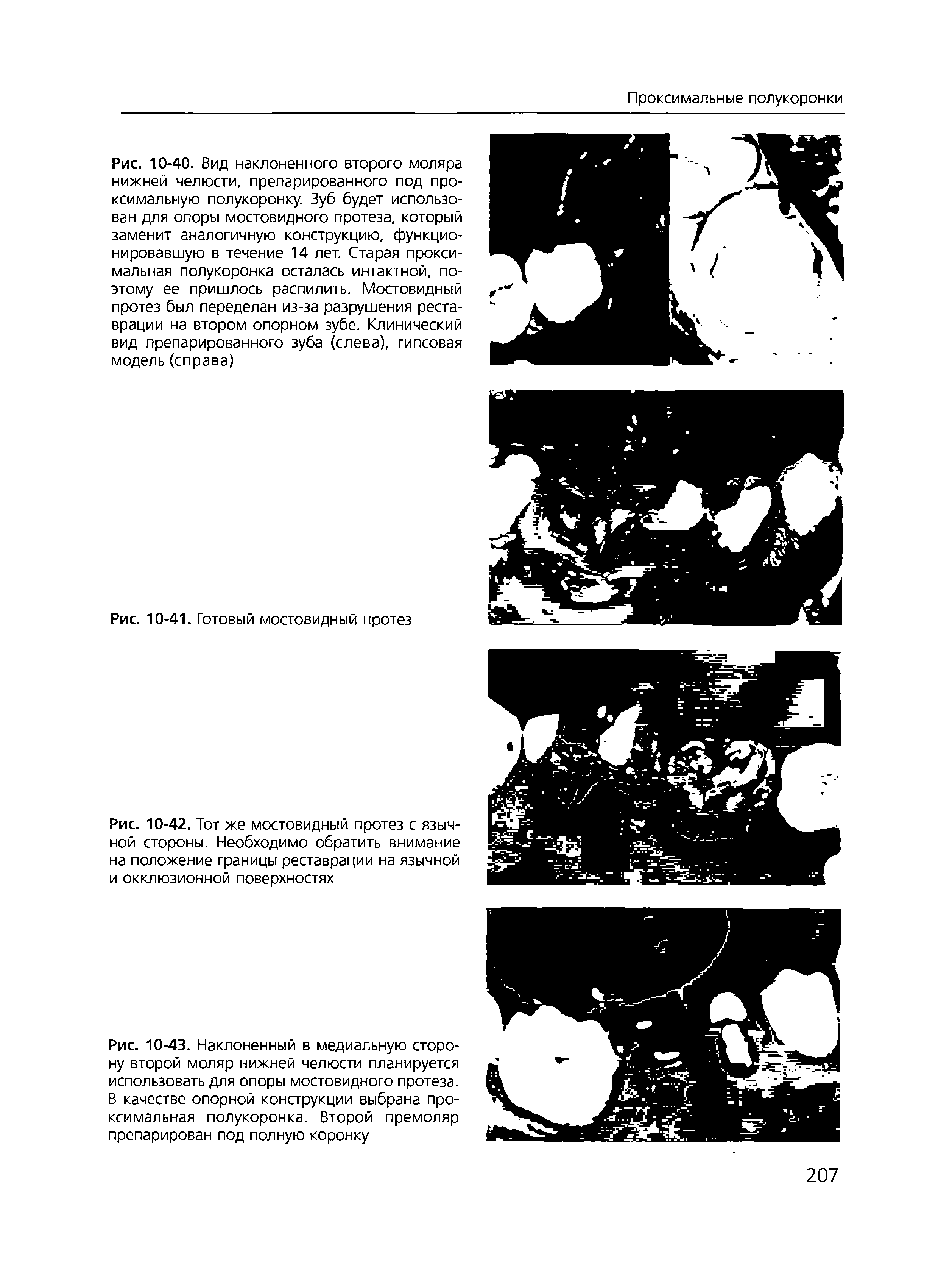 Рис. 10-43. Наклоненный в медиальную сторону второй моляр нижней челюсти планируется использовать для опоры мостовидного протеза. В качестве опорной конструкции выбрана проксимальная полукоронка. Второй премоляр препарирован под полную коронку...